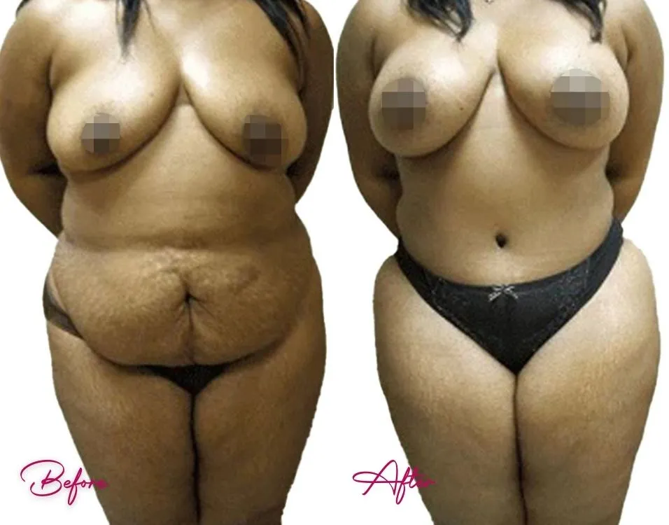 Tummy Tuck - Case 9