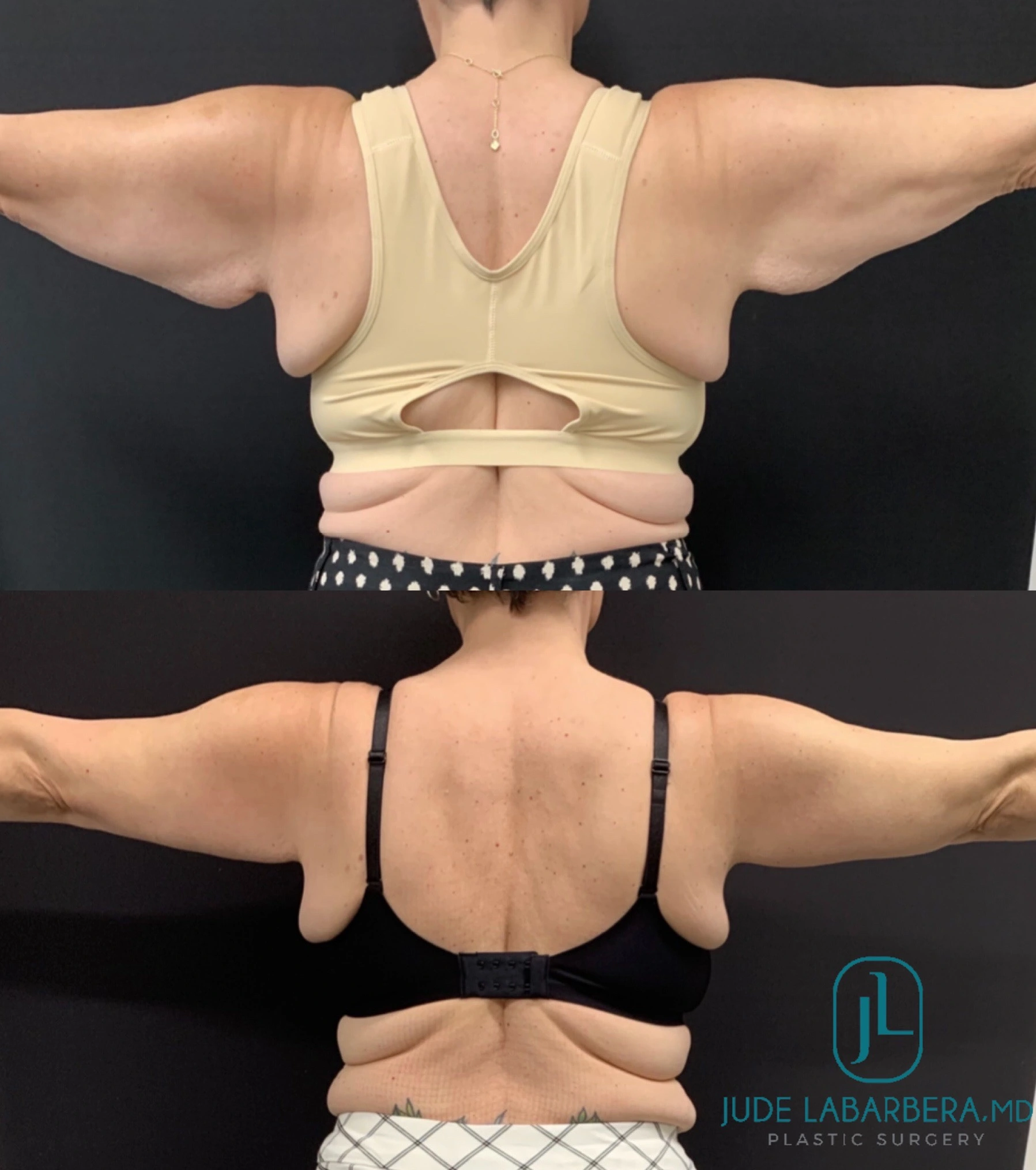 ARM LIFT Before & After Case Number 0002