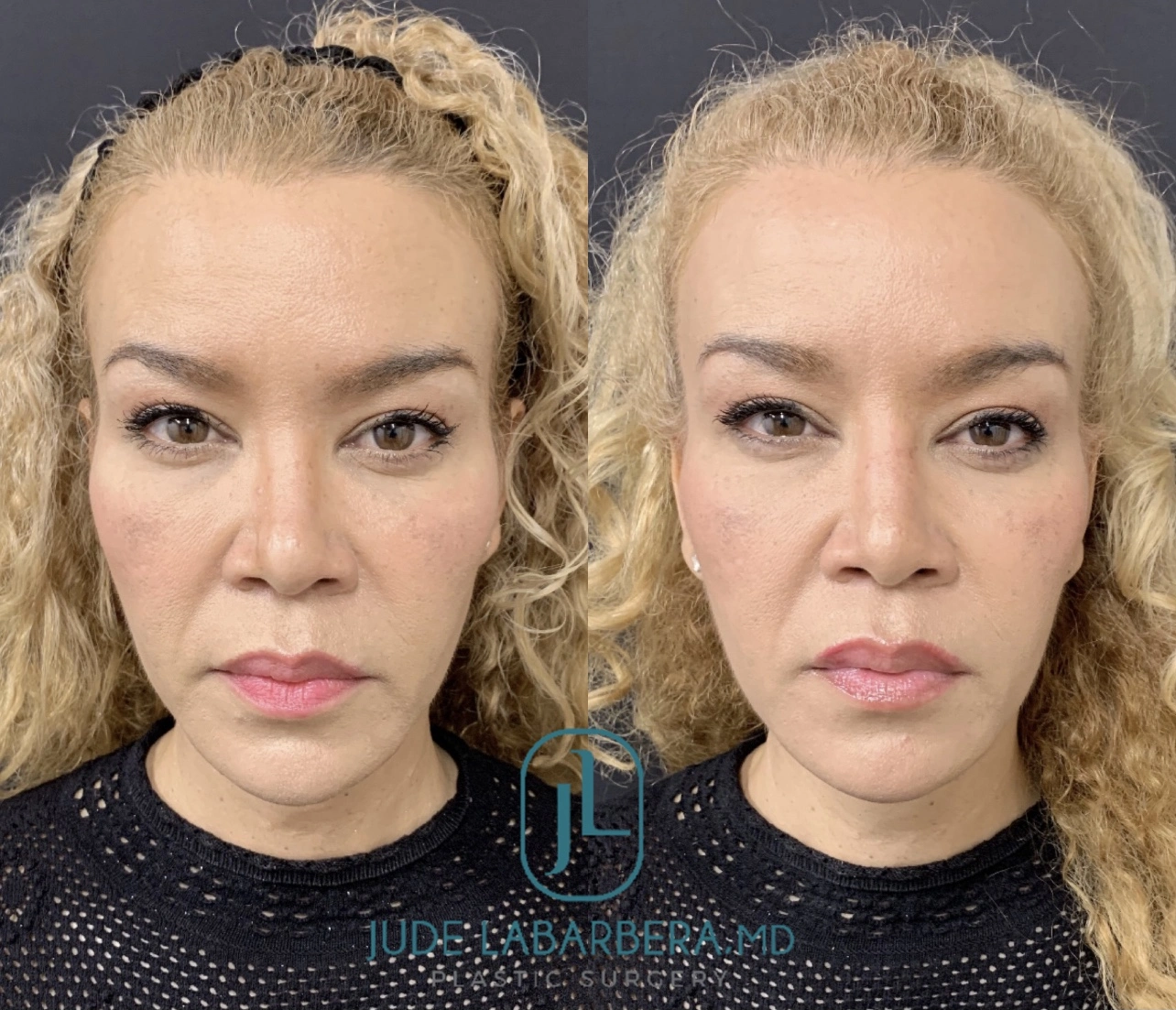 NON-SURGICAL RHINOPLASTY Before & After