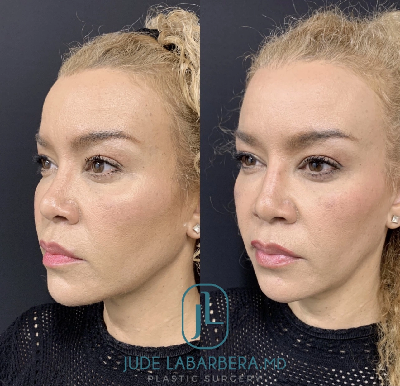 NON-SURGICAL RHINOPLASTY Before & After