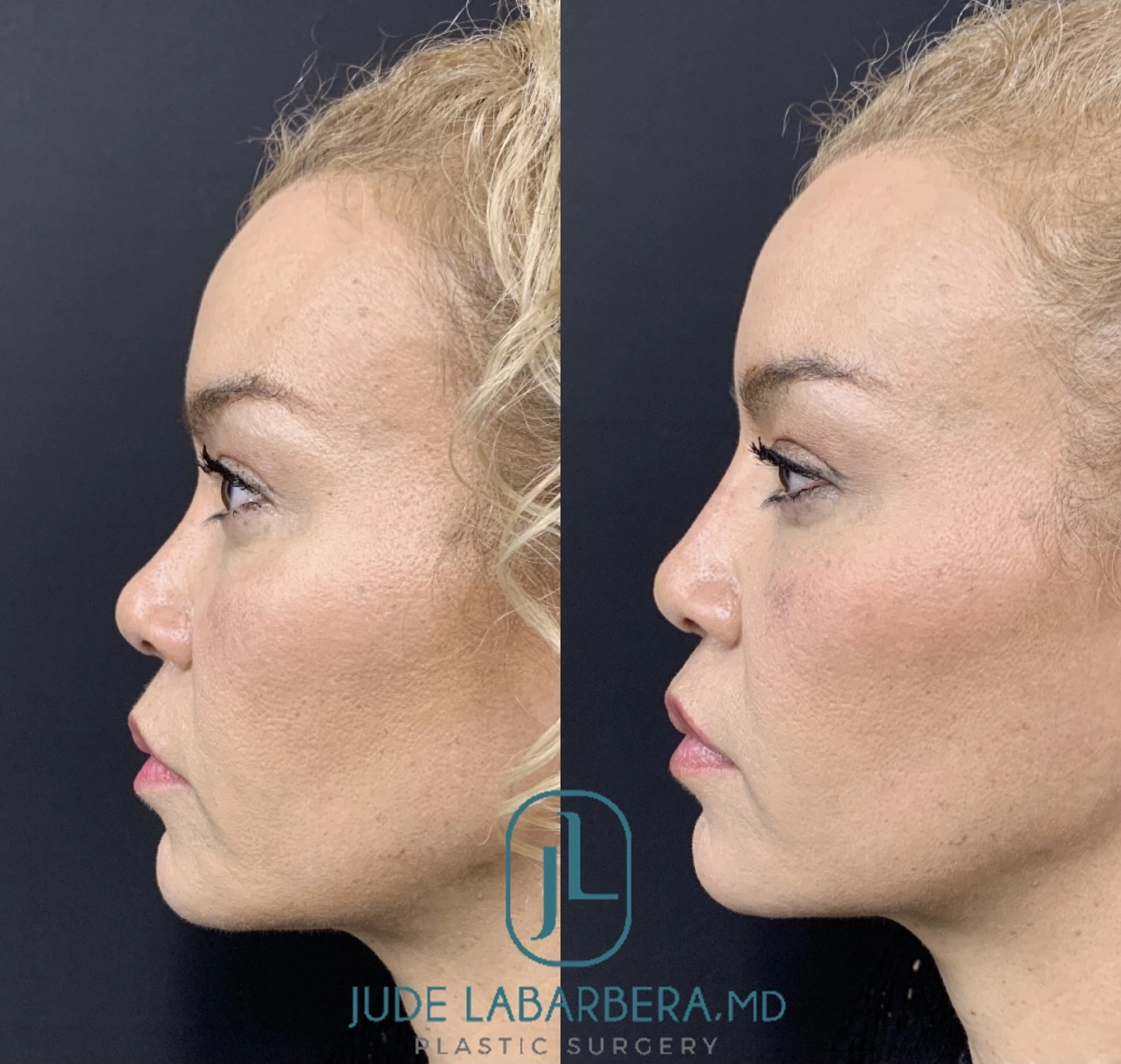 NON-SURGICAL RHINOPLASTY Before & After