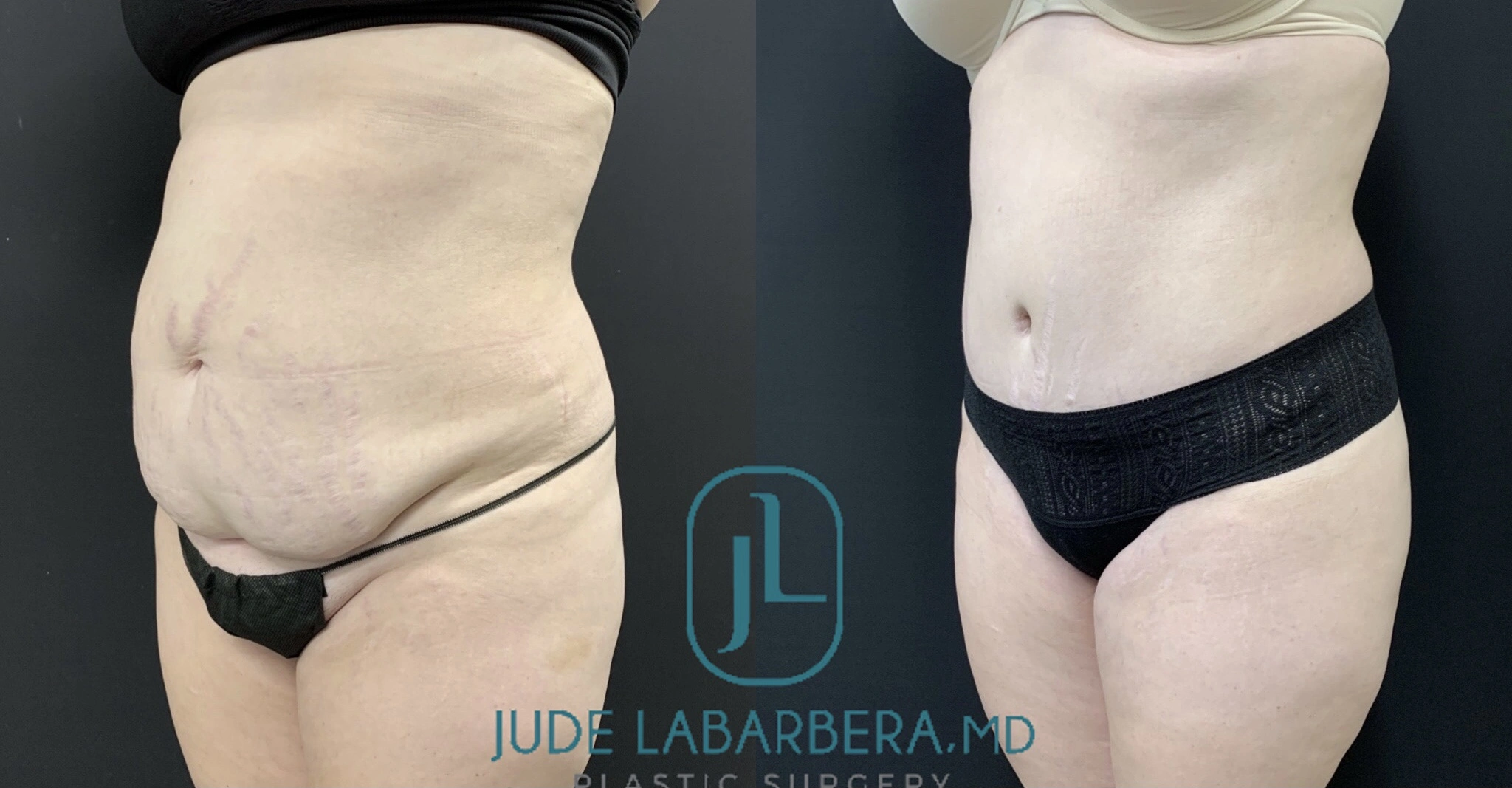 TUMMY TUCK Before & After