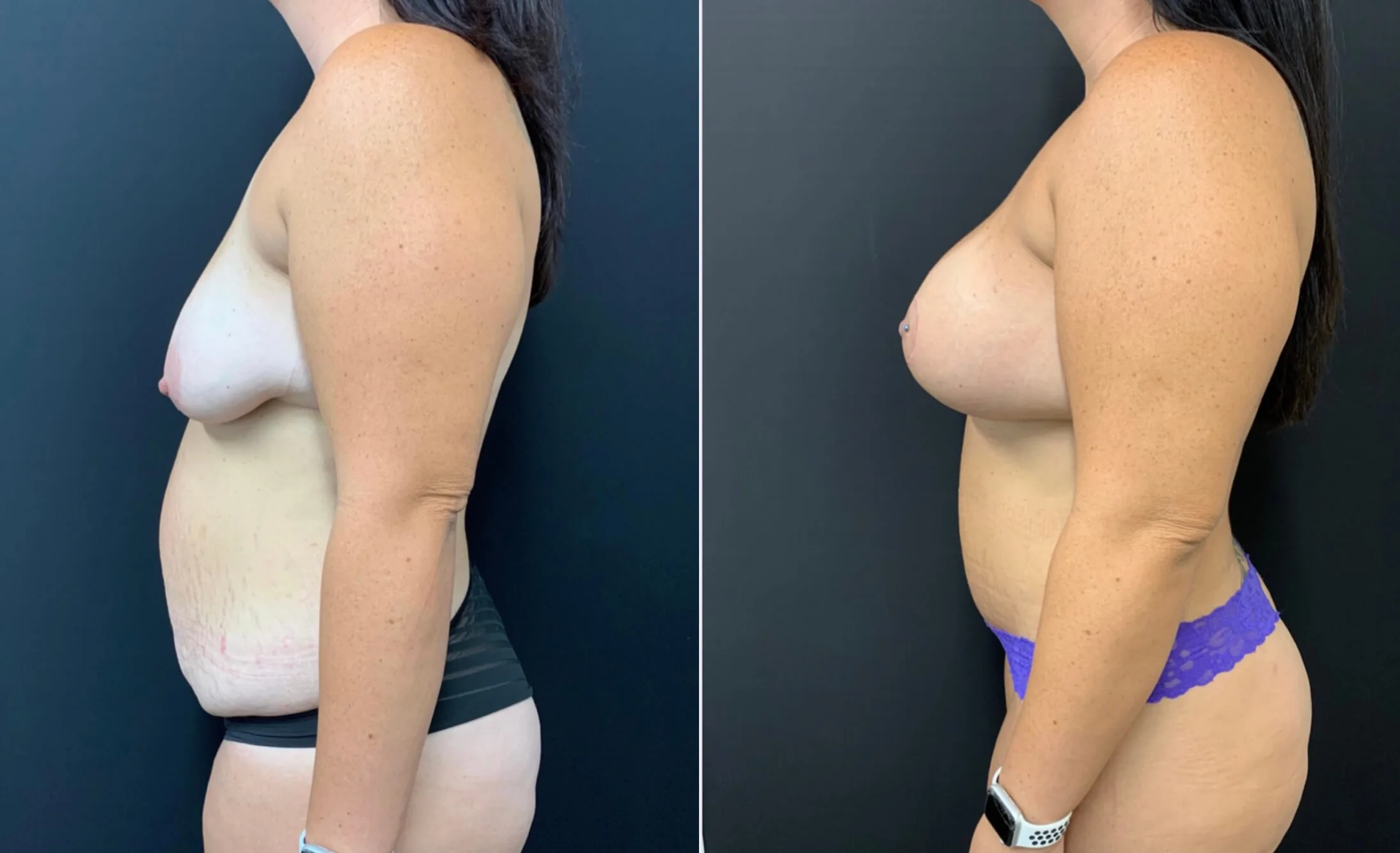 BEAUTIFUL ULTRA HIGH PROFILE BREAST AUGMENTATION WITH LIFT AND TUMMY TUCK Before & After