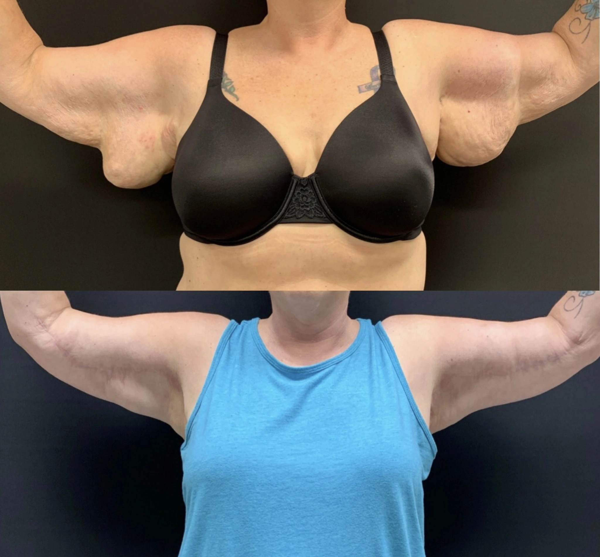 ARM LIFT Before & After Case Number 0001