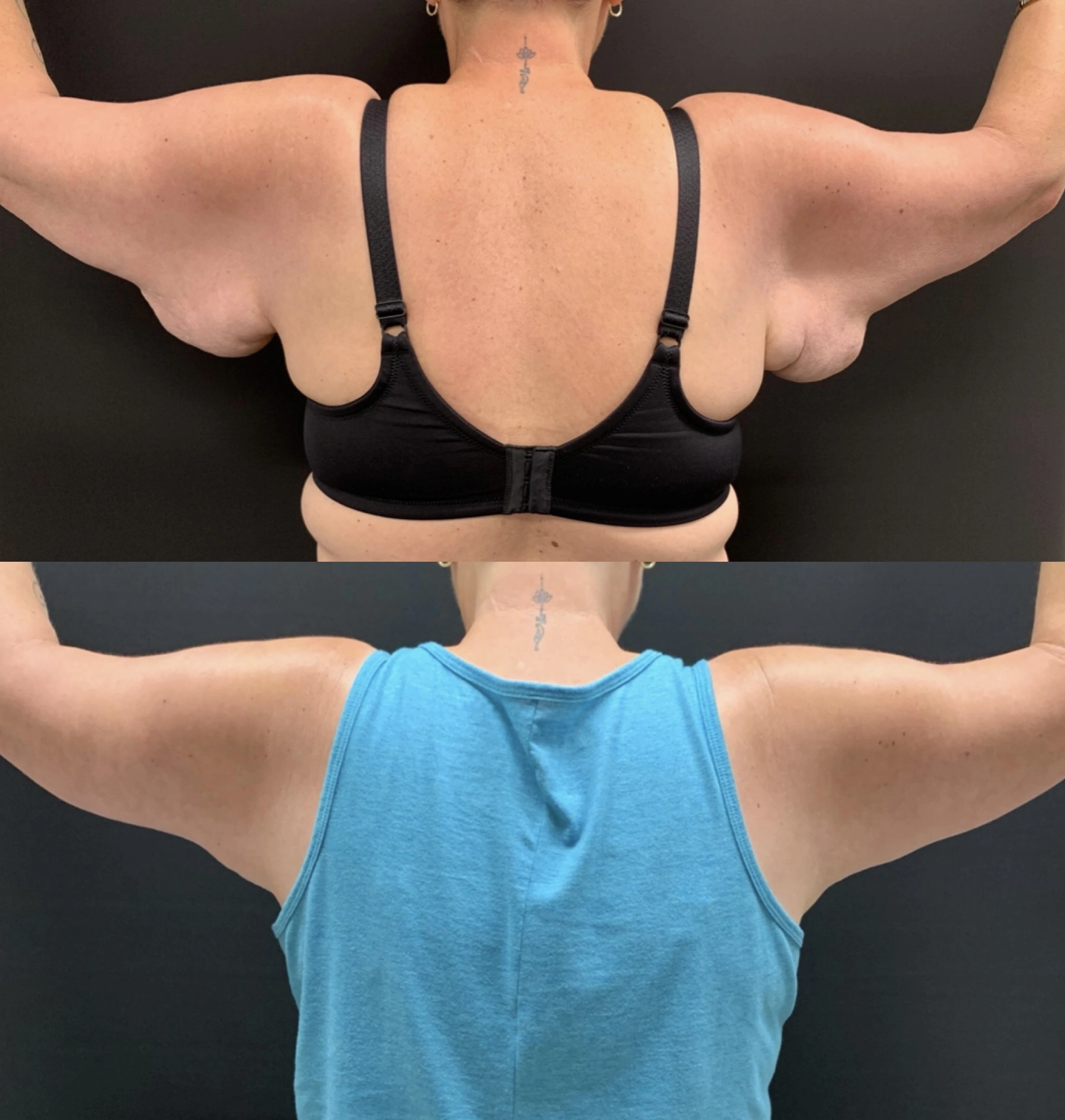 ARM LIFT Before & After Case Number 0001
