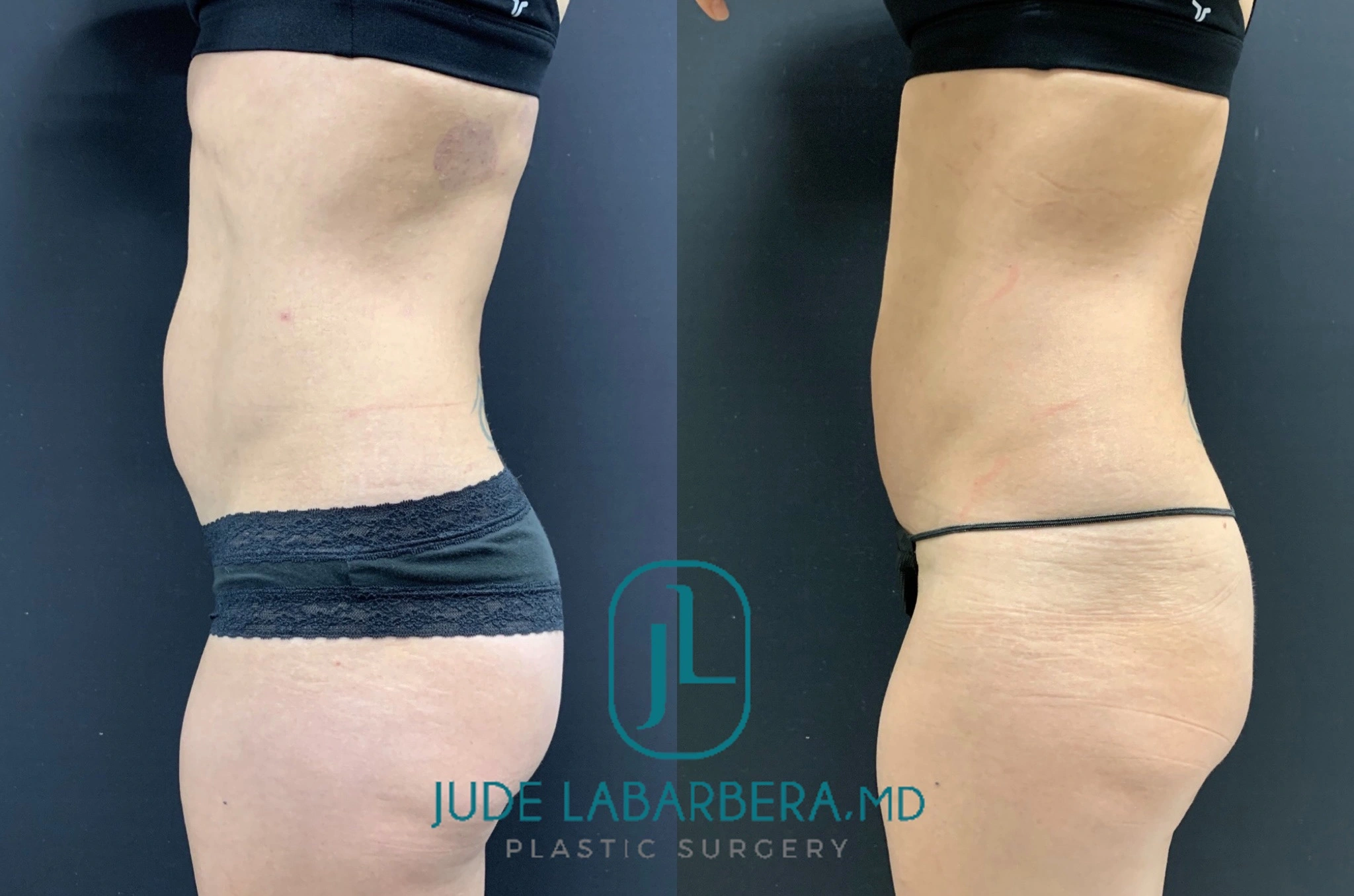BEAUTIFUL MINI TUMMY TUCK WITH UMBILICAL HERNIA Before & After Case Number 000115