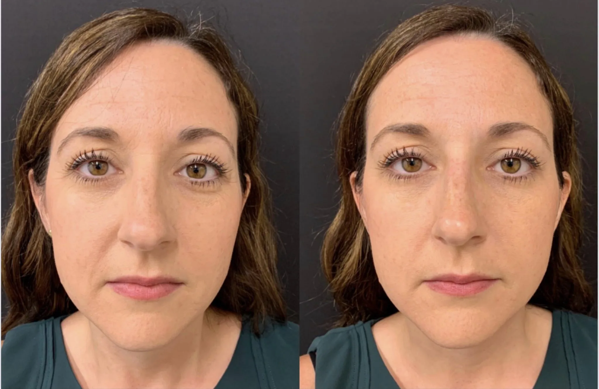 BEAUTIFUL NON-SURGICAL RHINOPLASTY Before & After Case Number 0006