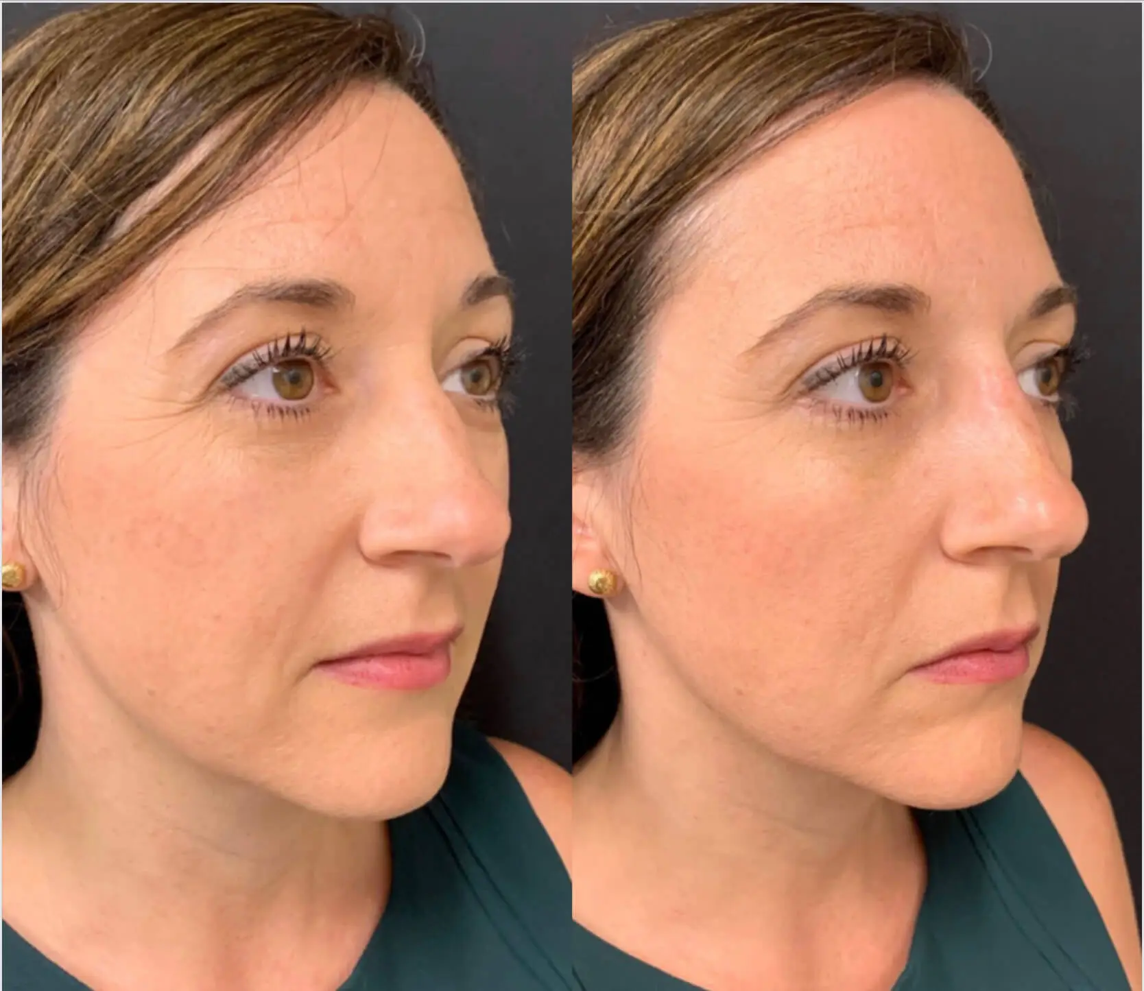 BEAUTIFUL NON-SURGICAL RHINOPLASTY Before & After Case Number 0006