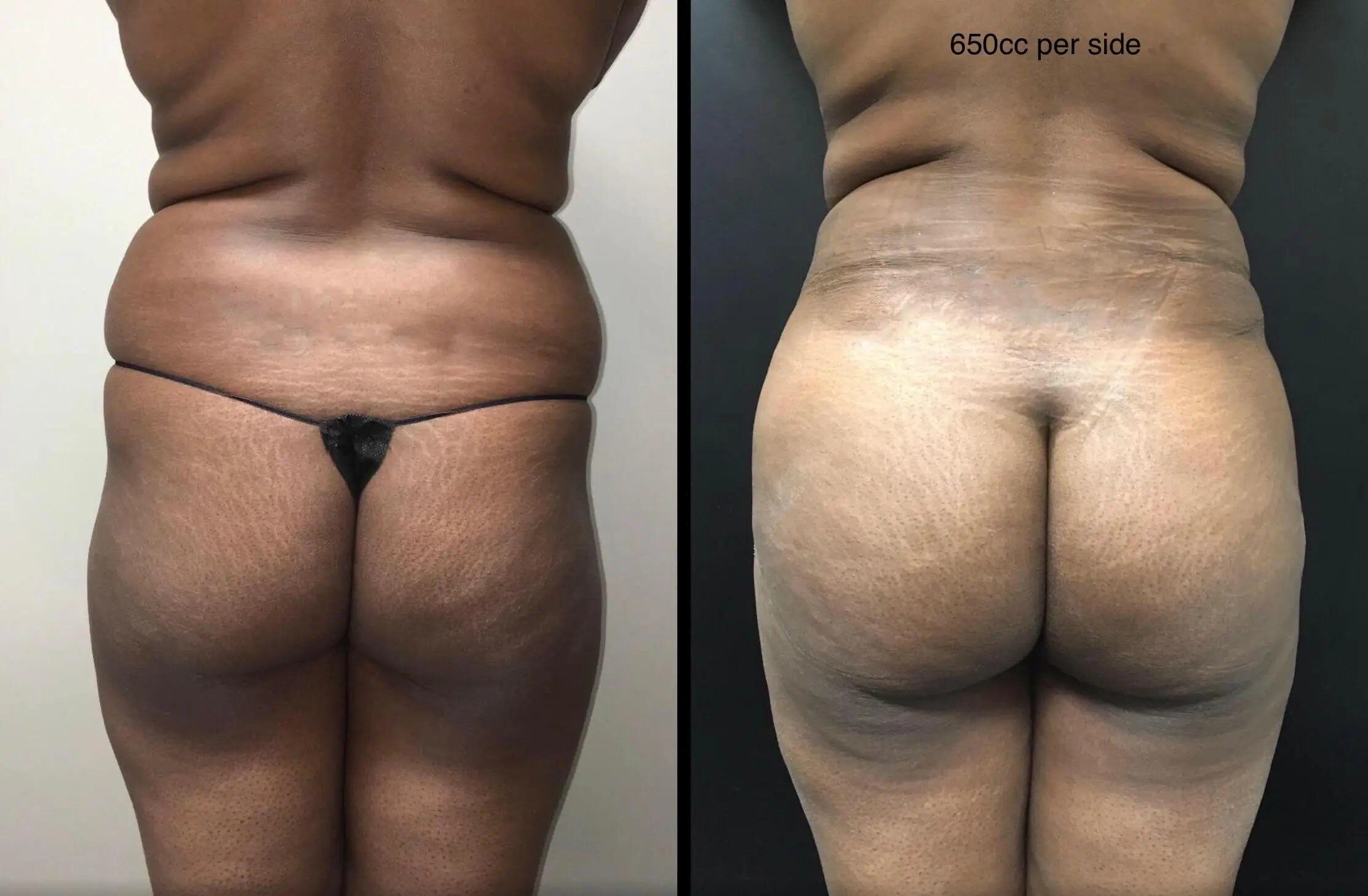 BRAZILIAN BUTT LIFT Before & After Case Number 0004