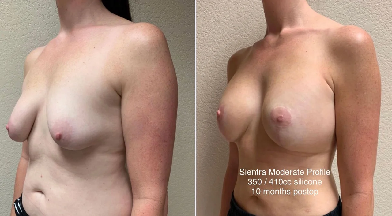 BREAST ASYMMETRY CORRECTION Before & After Case Number 0001