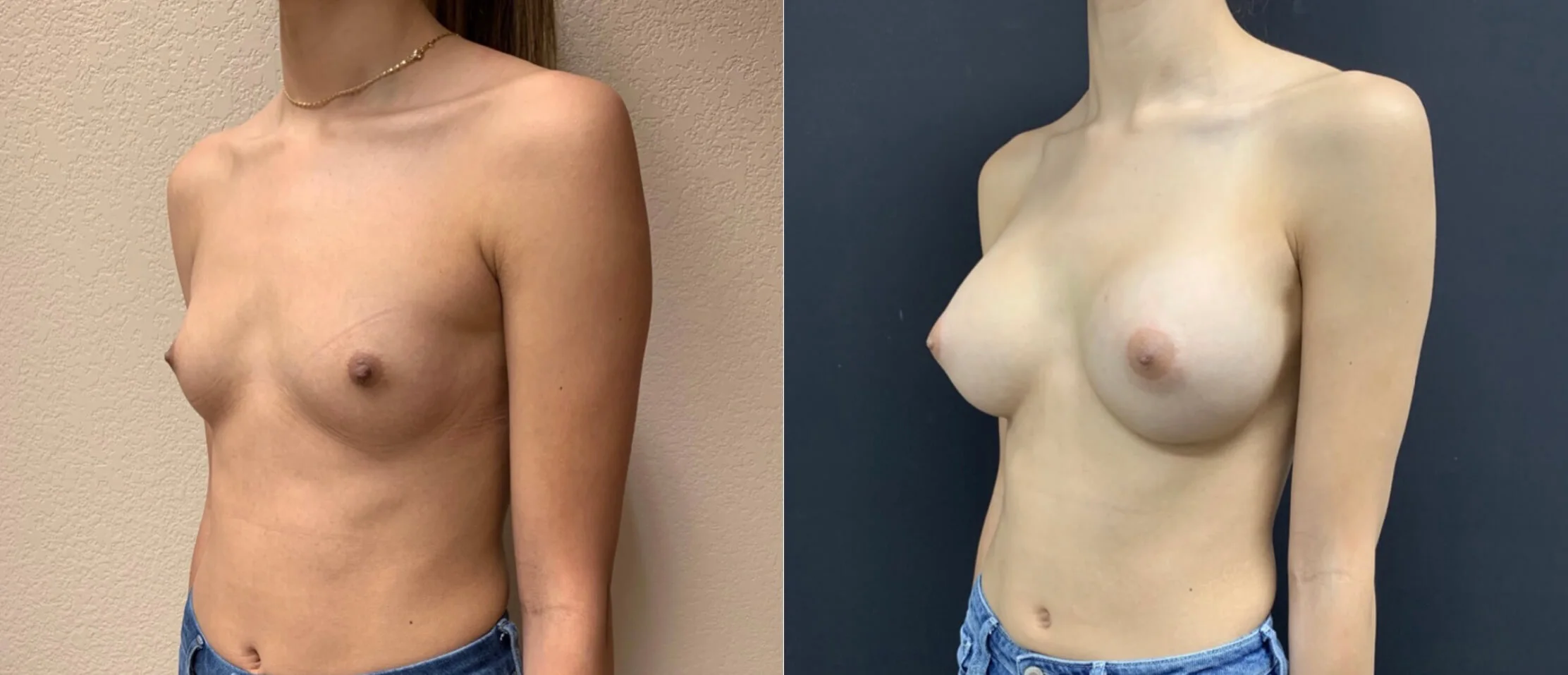BREAST AUGMENTATION Before & After case 0001