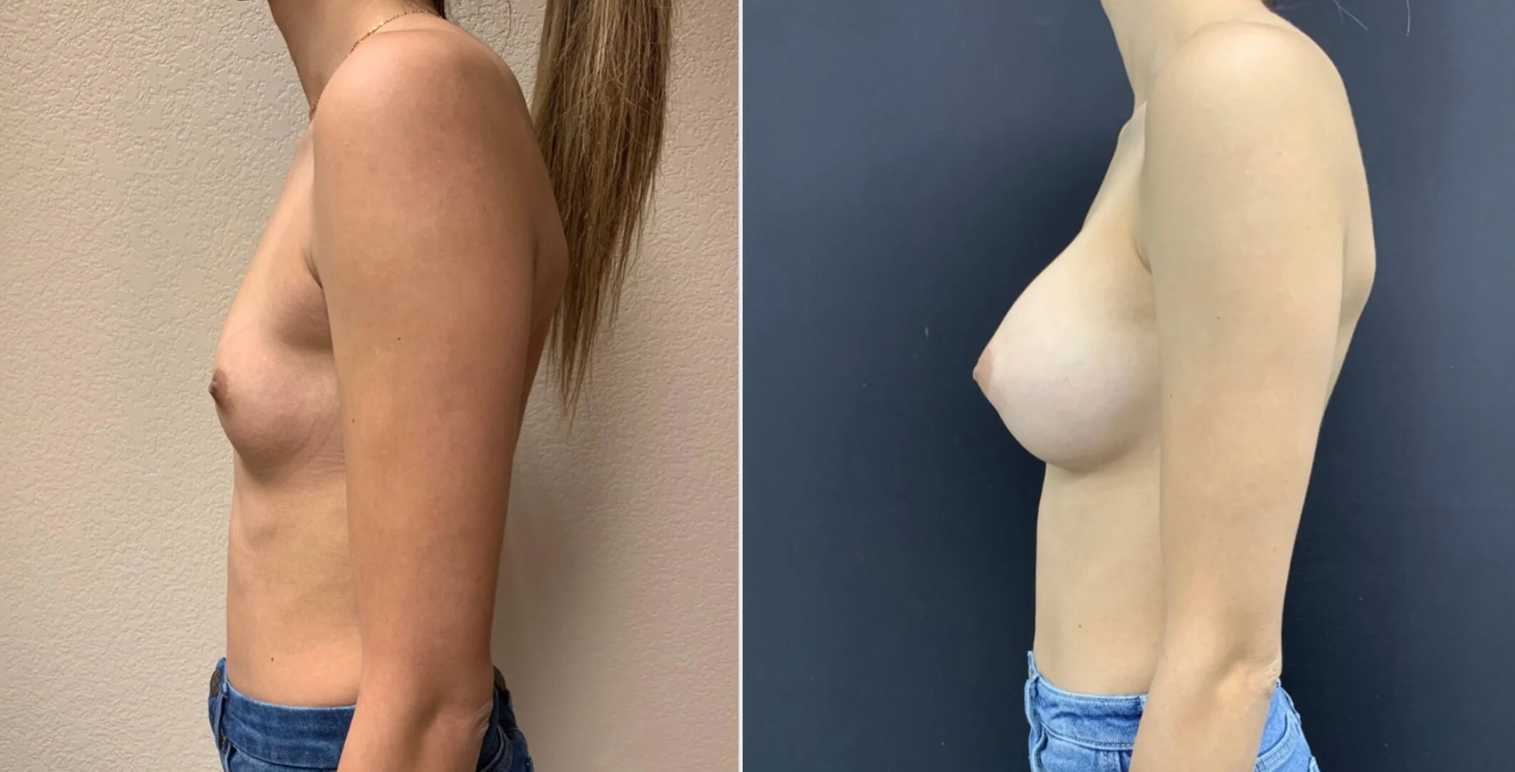 BREAST AUGMENTATION Before & After case 0001