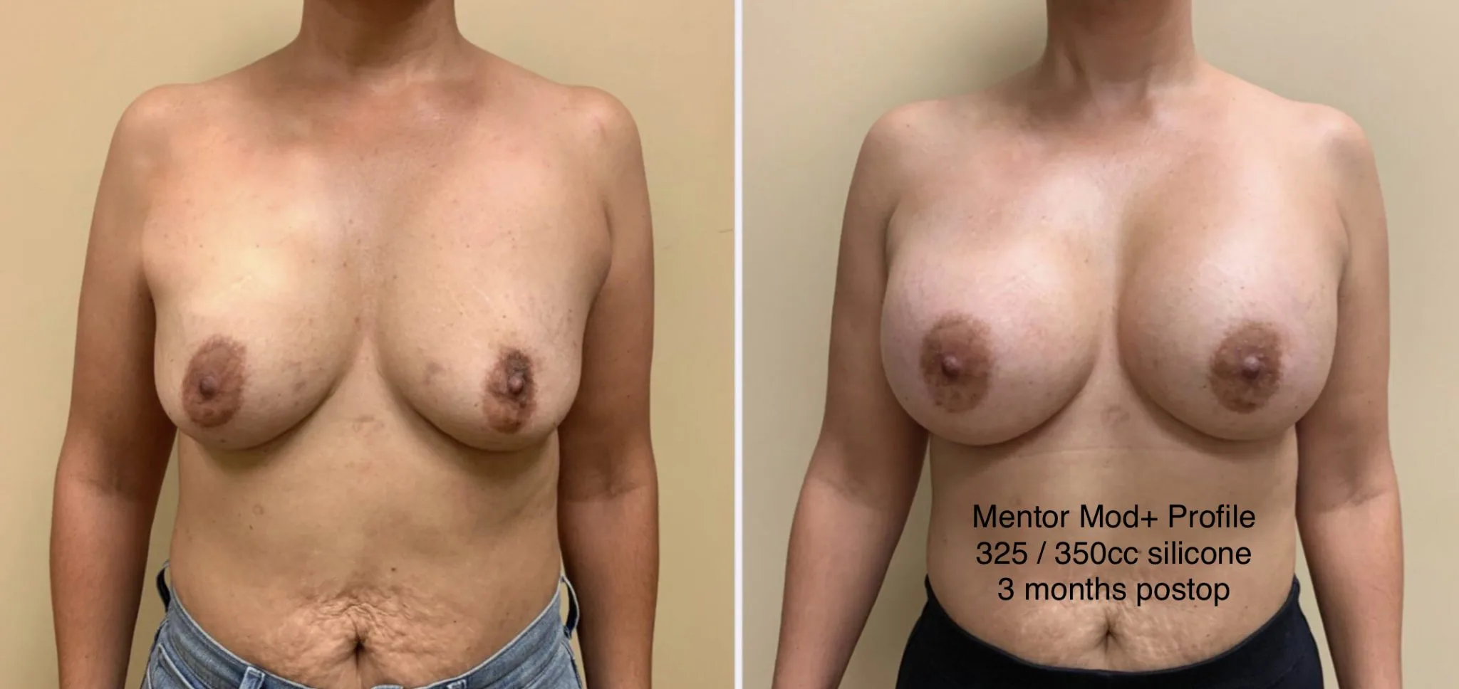 BREAST AUGMENTATION Before & After Case Number 00013