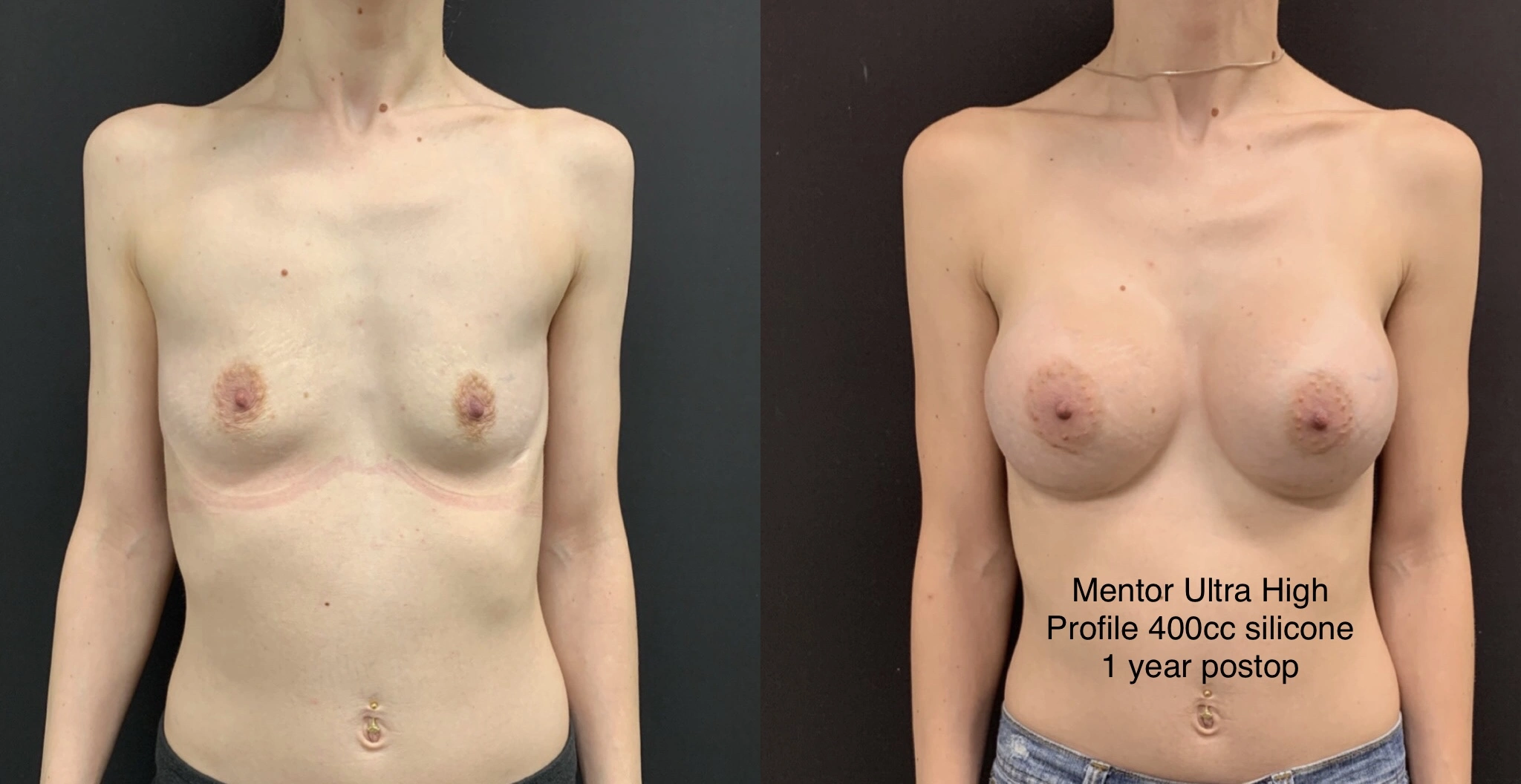 BREAST AUGMENTATION Before & After Case Number 00014