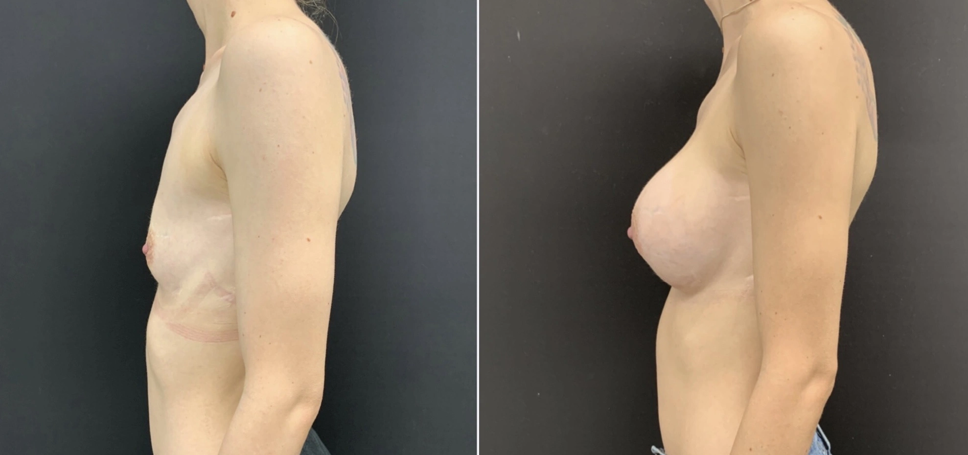 BREAST AUGMENTATION Before & After Case Number 00014