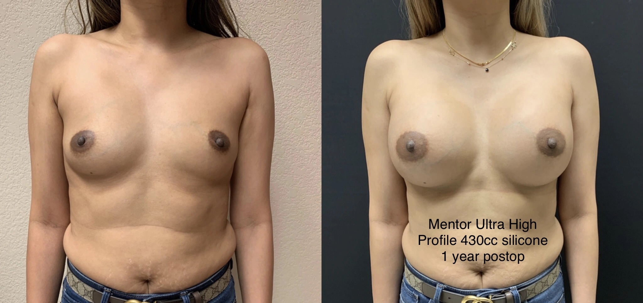 BREAST AUGMENTATION Before & After Case Number 00017