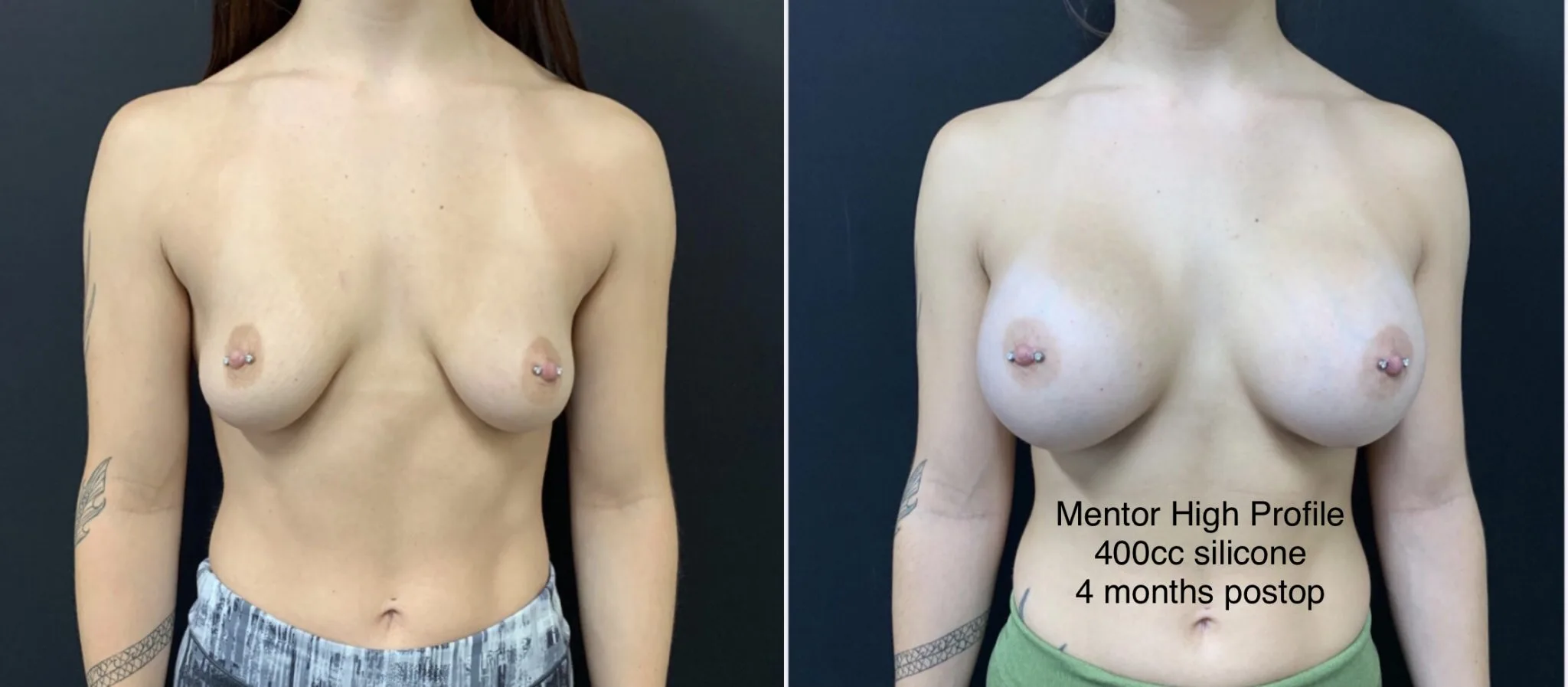 BREAST AUGMENTATION Before & After Case Number 00019