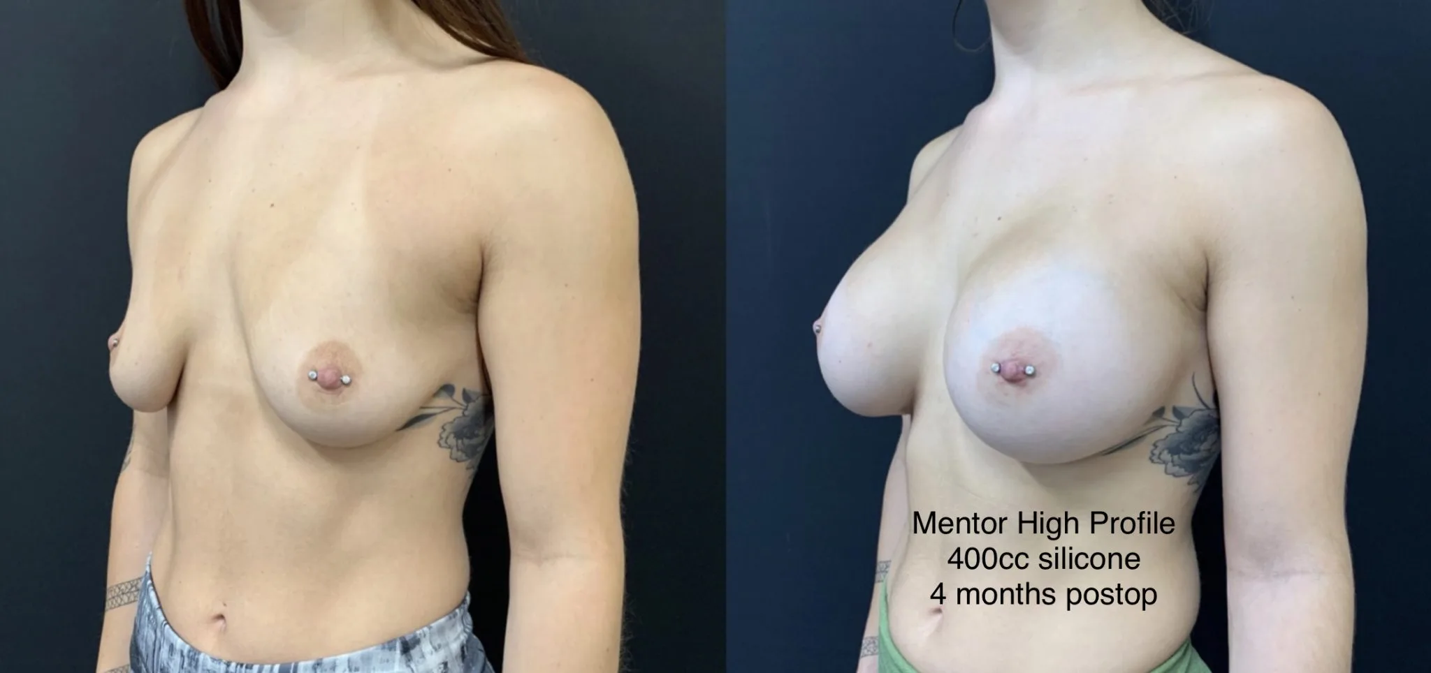 BREAST AUGMENTATION Before & After Case Number 00019