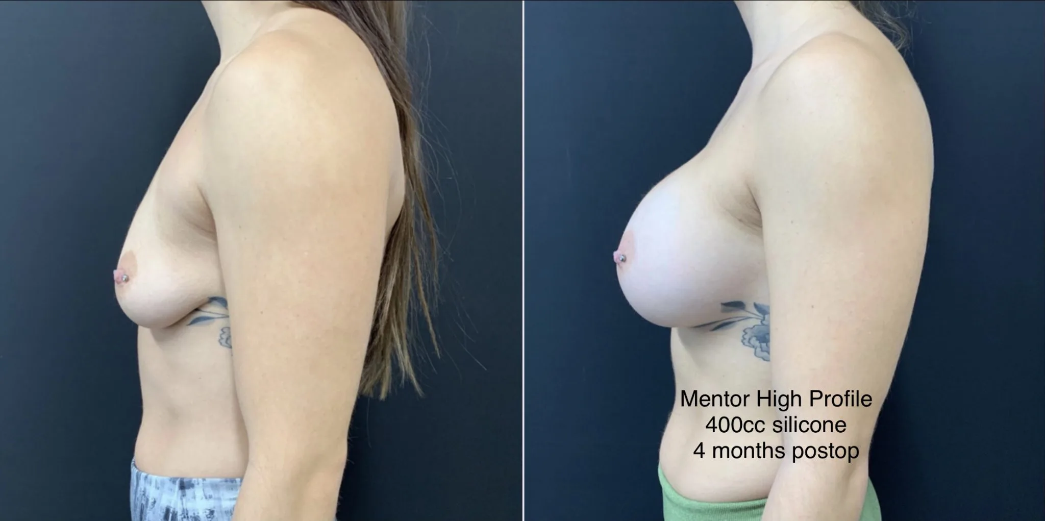 BREAST AUGMENTATION Before & After Case Number 00019
