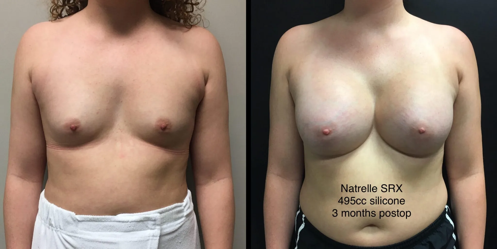 BREAST AUGMENTATION Before & After Case Number 00023