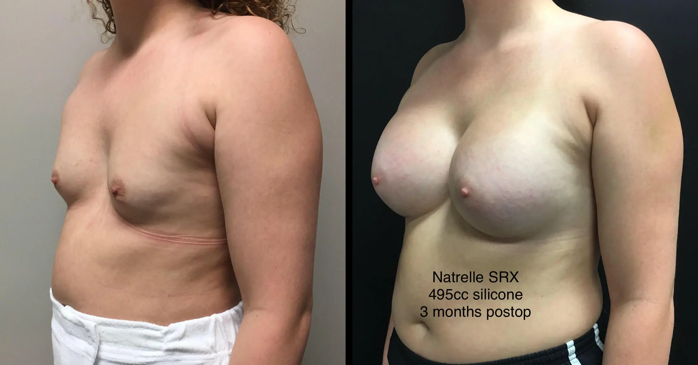 BREAST AUGMENTATION Before & After Case Number 00023