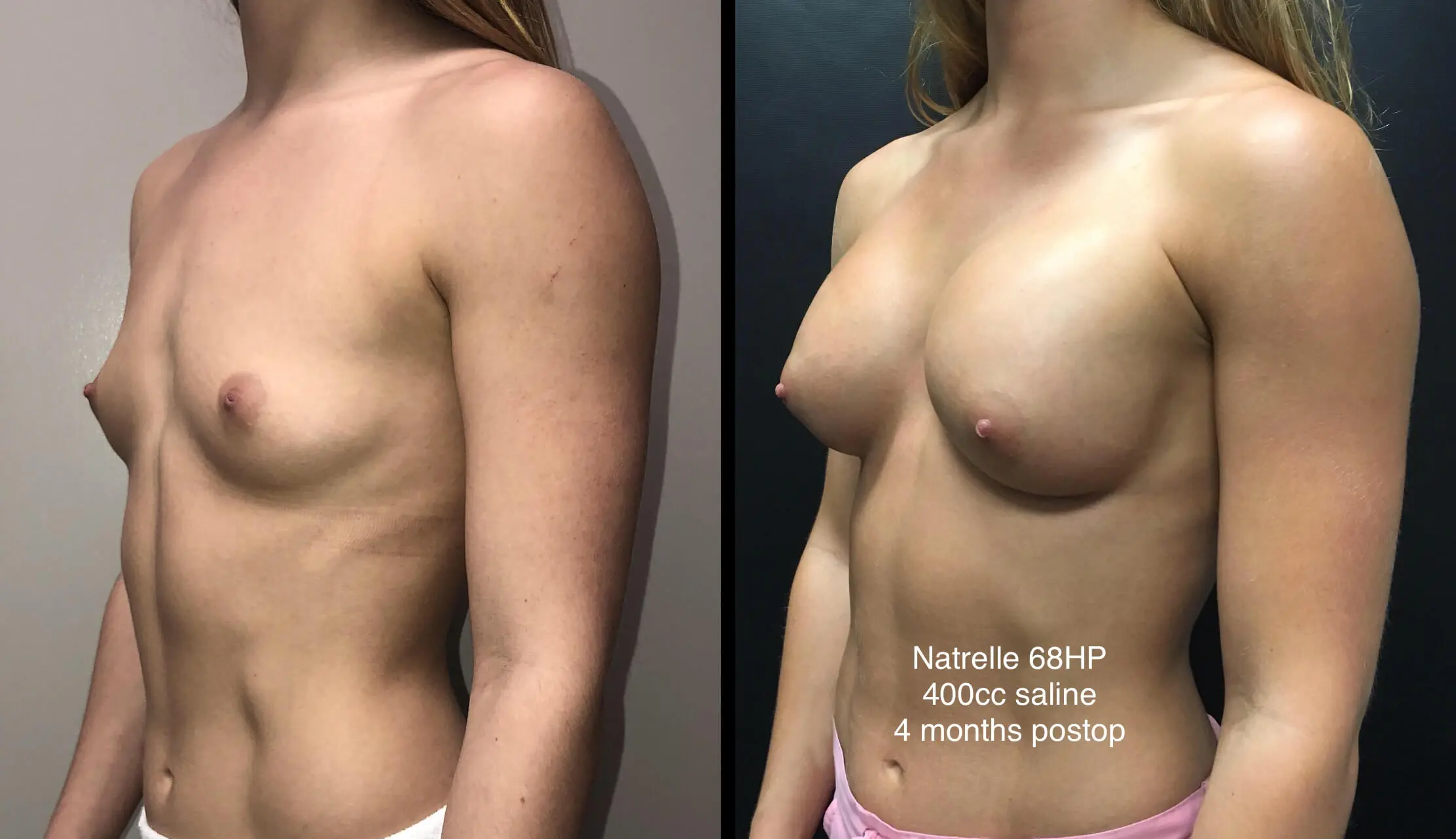 BREAST AUGMENTATION Before & After Case Number 00025