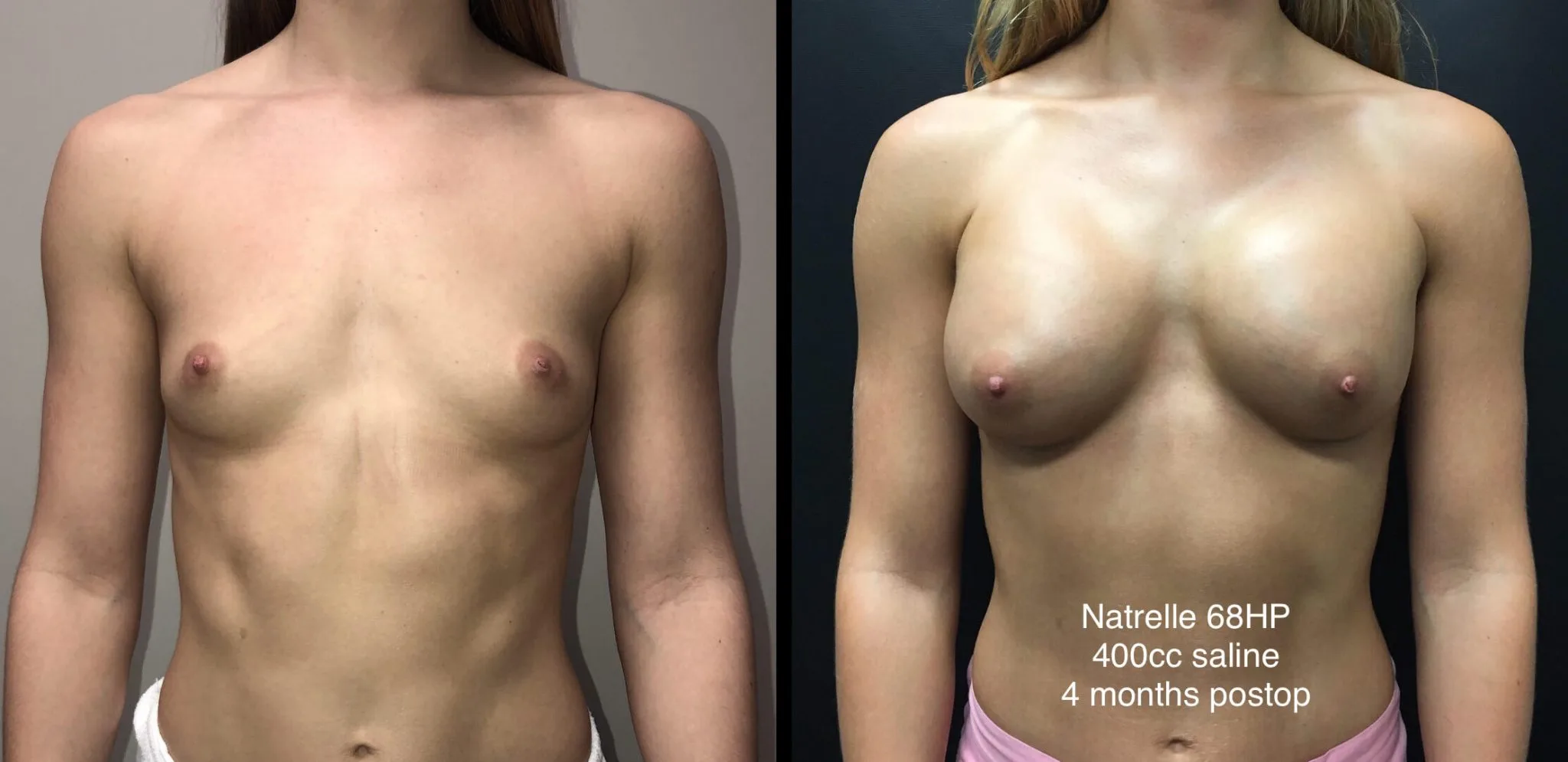 BREAST AUGMENTATION Before & After Case Number 00025