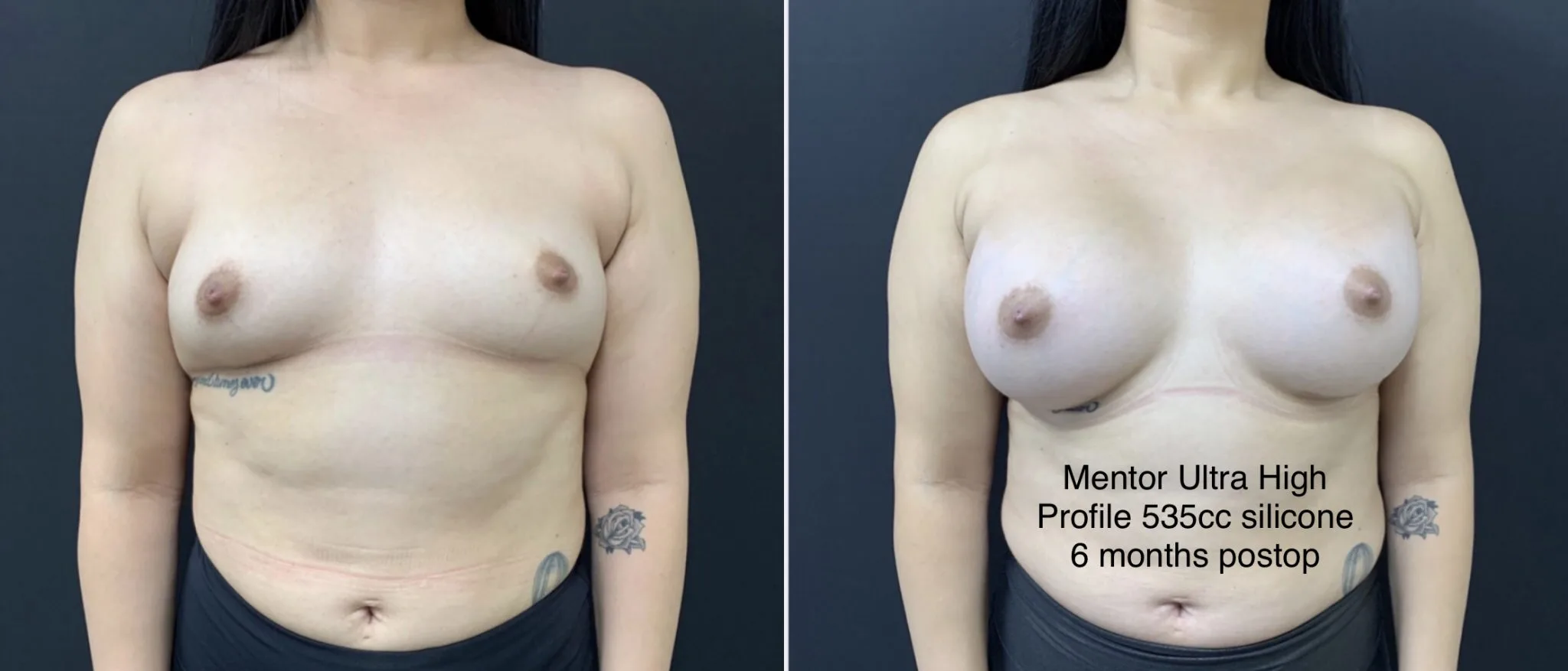 BREAST AUGMENTATION Before & After Case Number 00027