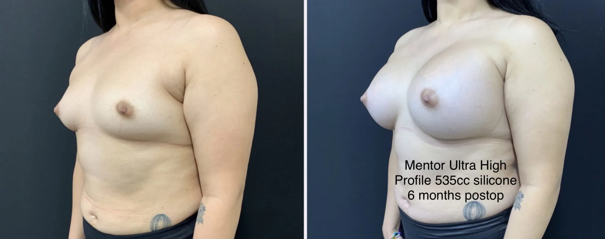 BREAST AUGMENTATION Before & After Case Number 00027