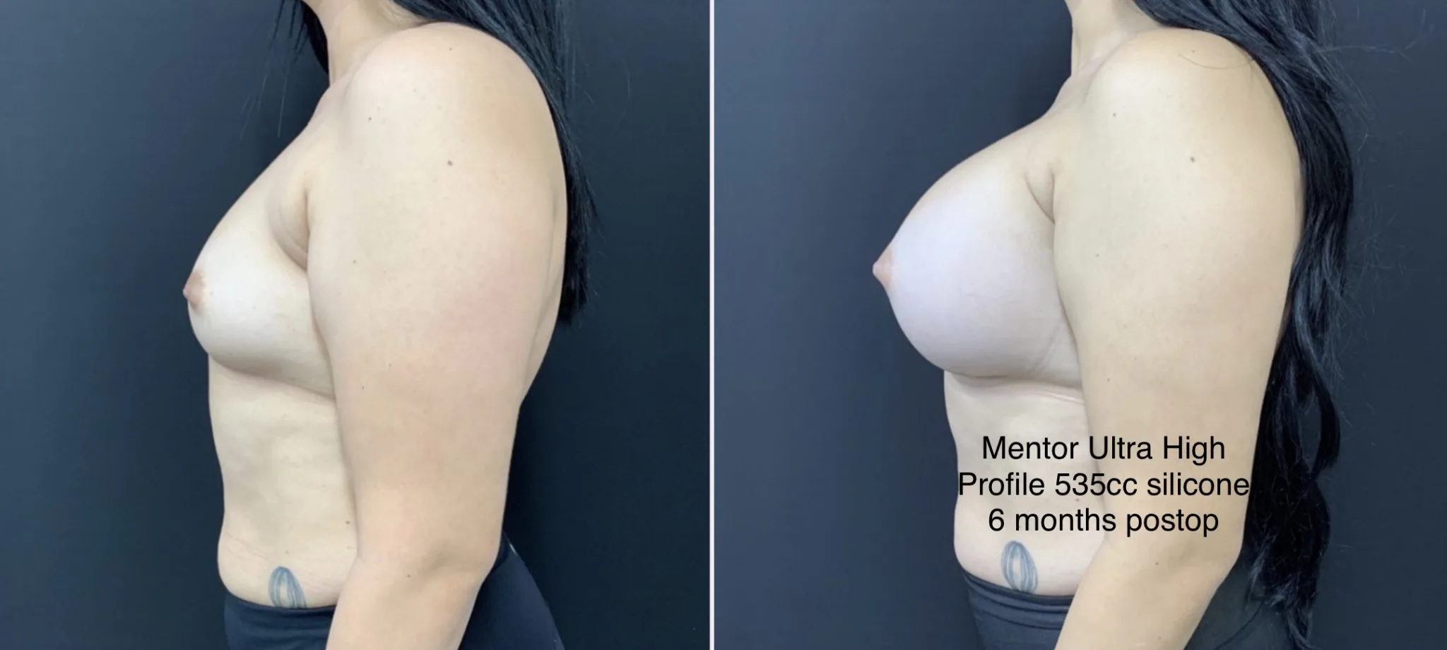 BREAST AUGMENTATION Before & After Case Number 00027