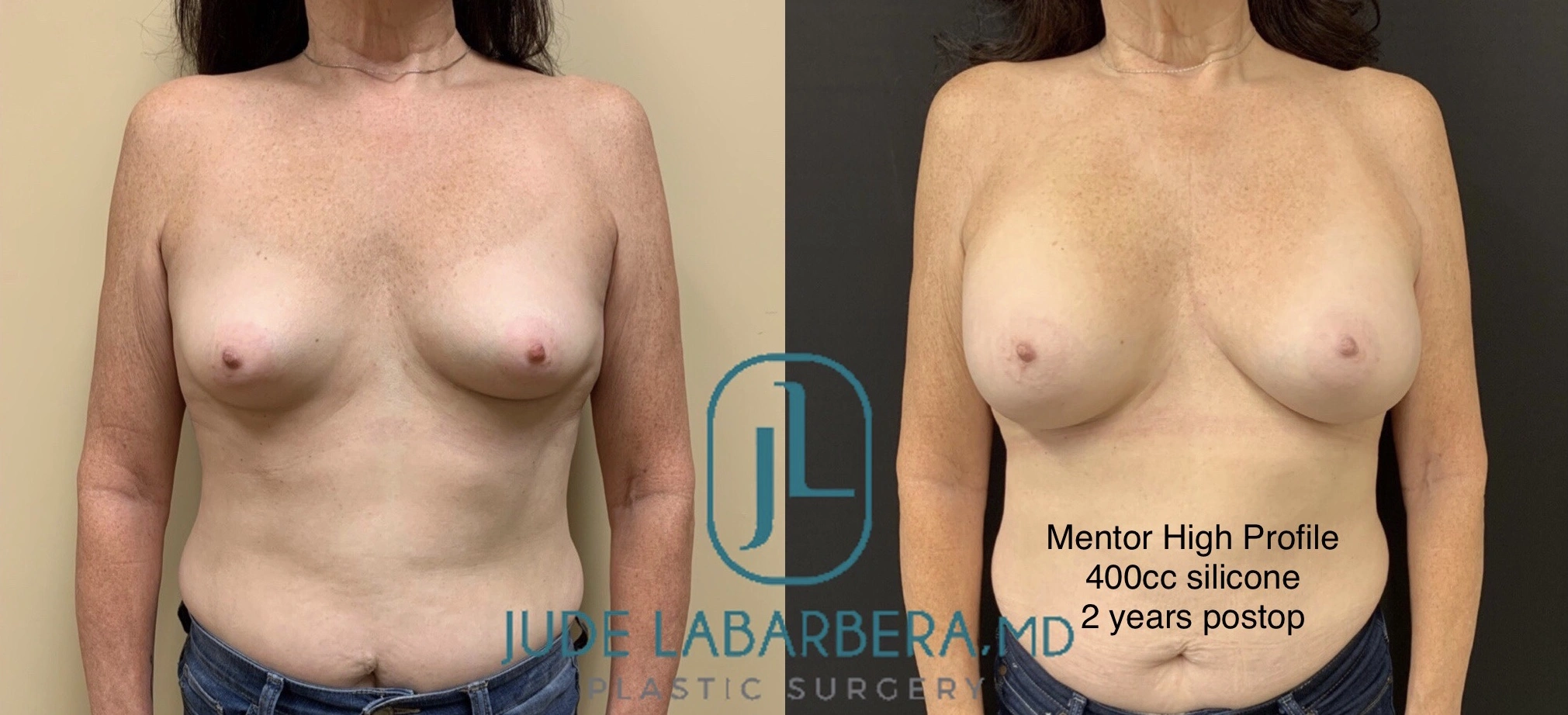 BREAST AUGMENTATION Before & After Case Number 00031