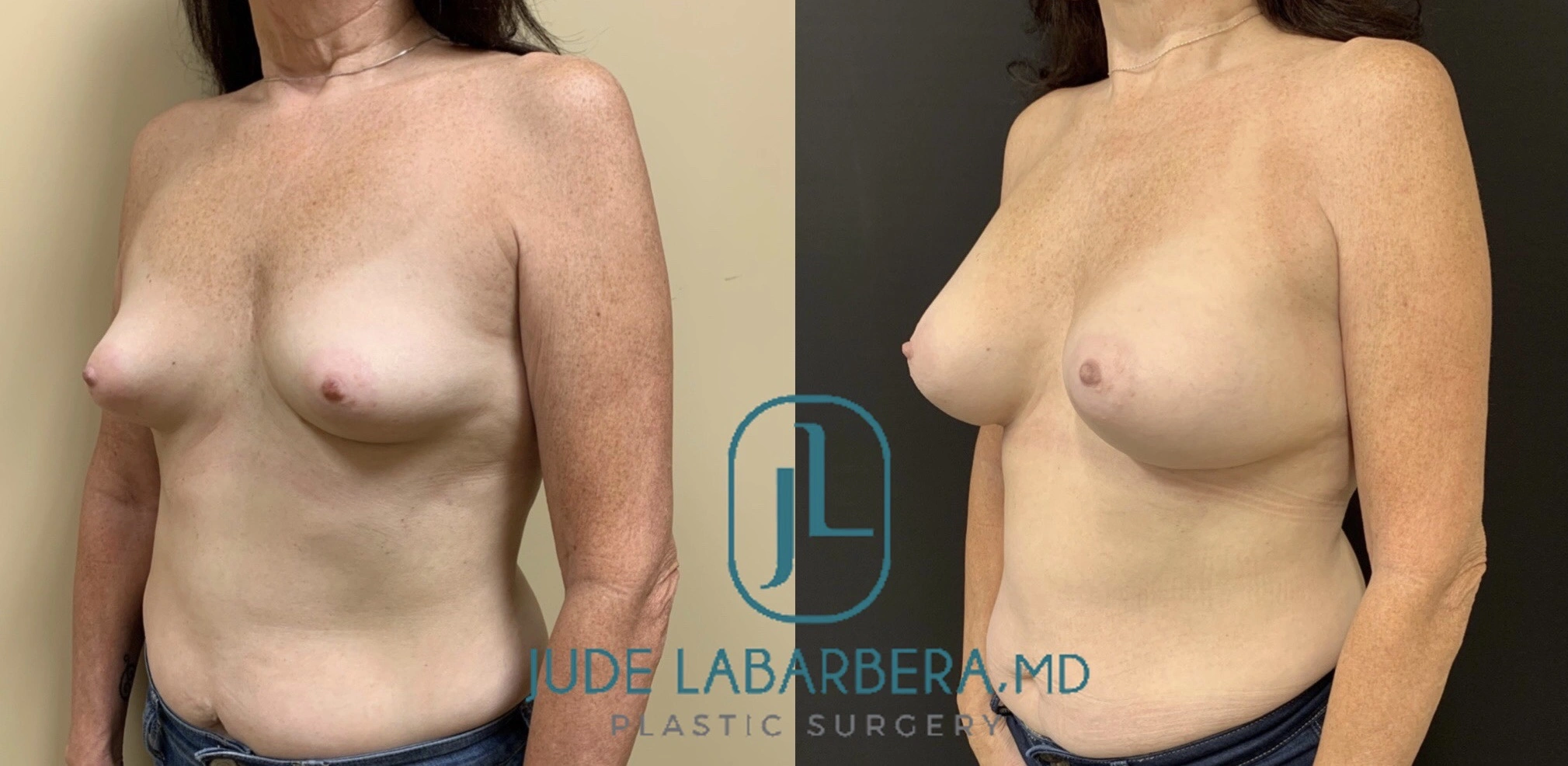 BREAST AUGMENTATION Before & After Case Number 00031