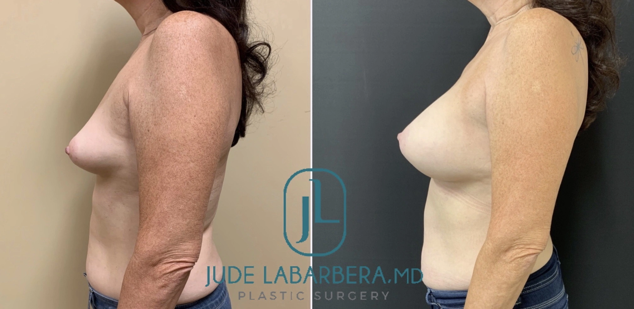 BREAST AUGMENTATION Before & After Case Number 00031