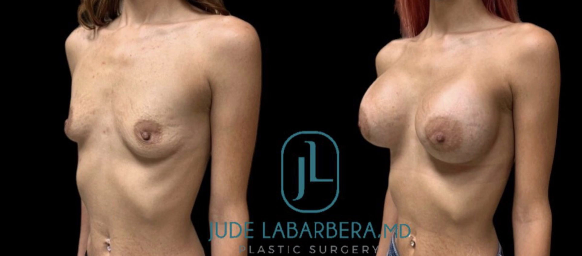 BREAST AUGMENTATION Before & After Case Number 00032
