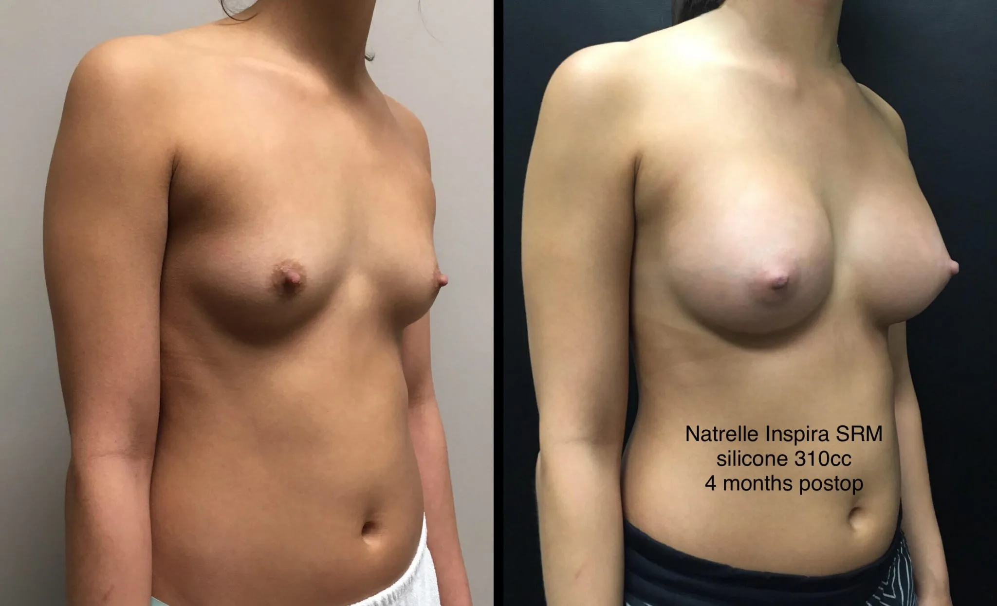 BREAST AUGMENTATION Before & After Case Number 00037