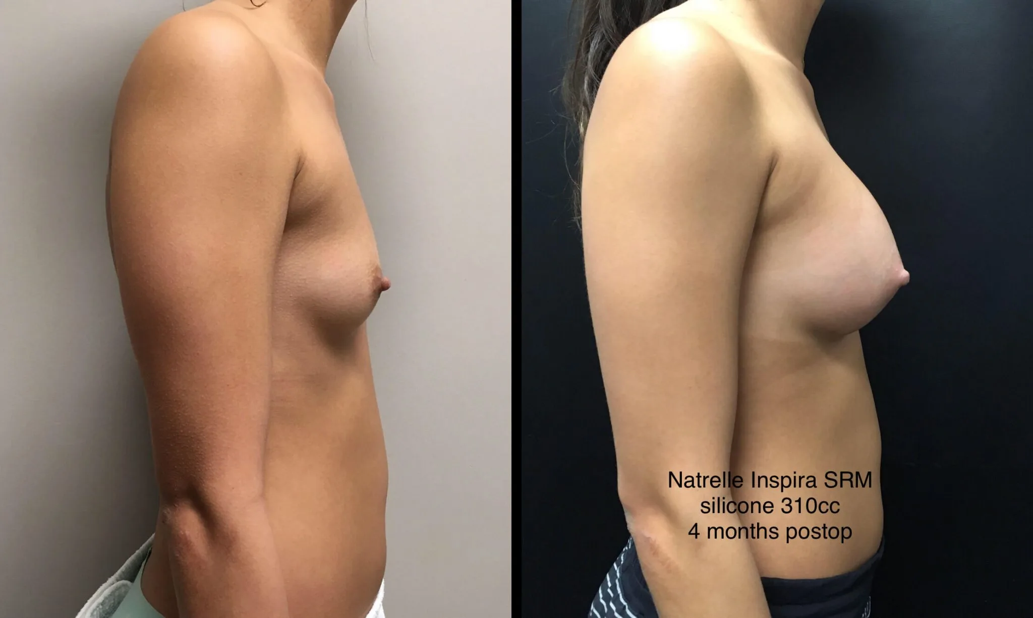 BREAST AUGMENTATION Before & After Case Number 00037
