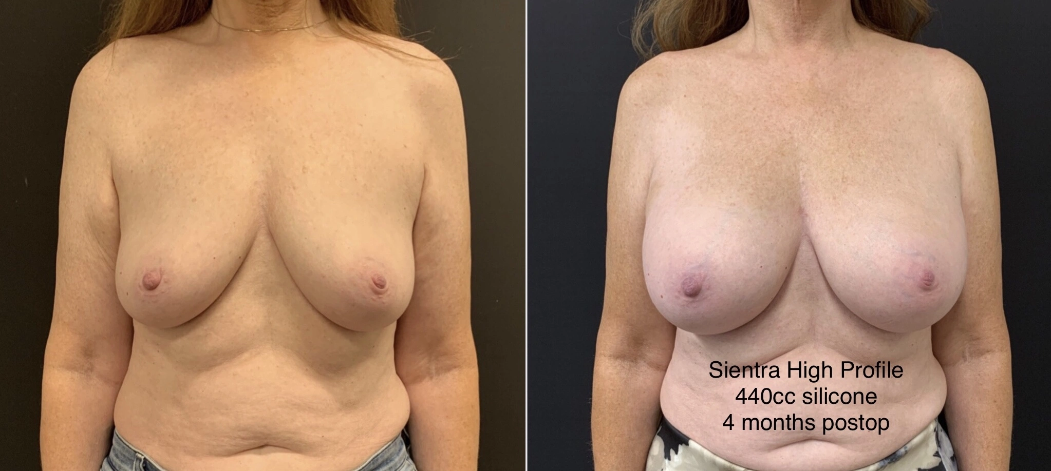 BREAST AUGMENTATION Before & After Case Number 00042