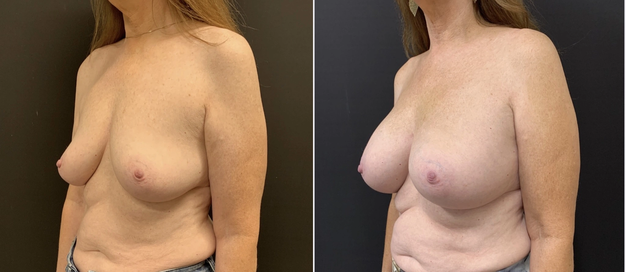 BREAST AUGMENTATION Before & After Case Number 00042