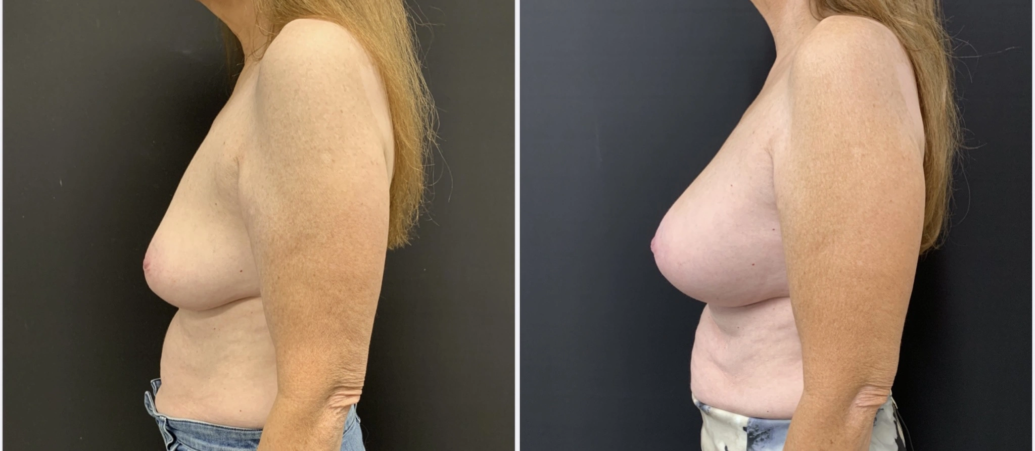 BREAST AUGMENTATION Before & After Case Number 00042