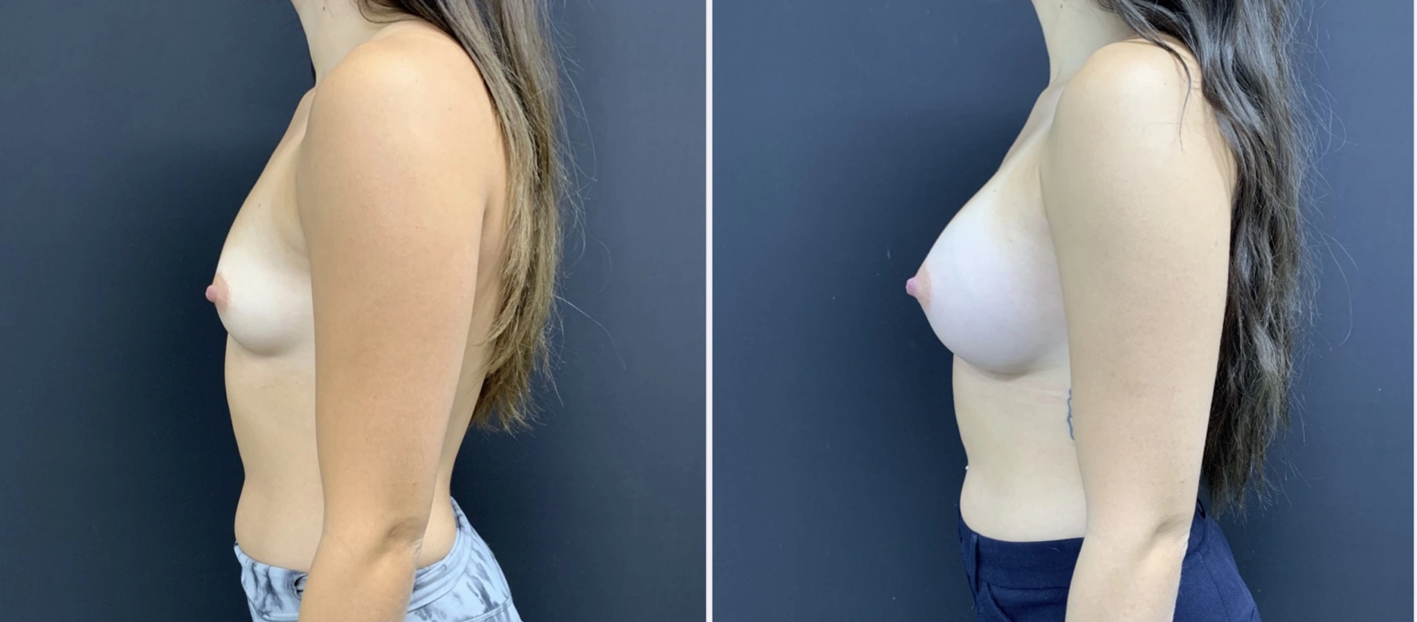 BREAST AUGMENTATION Before & After Case Number 00047