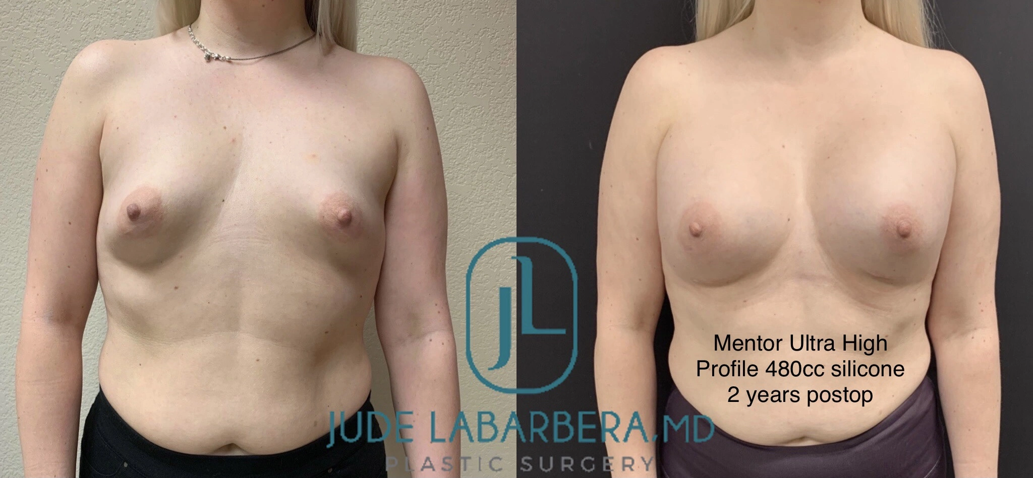 BREAST AUGMENTATION Before & After Case Number 0005