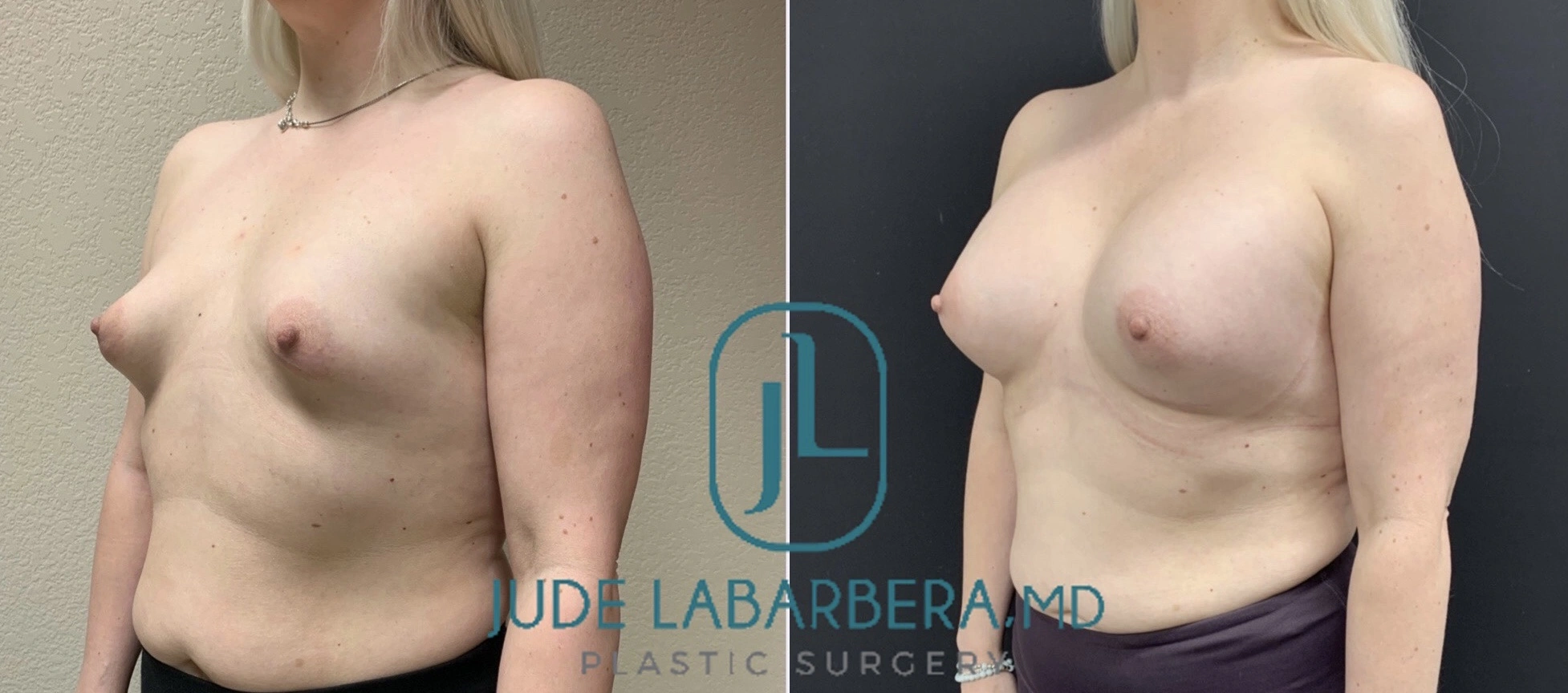 BREAST AUGMENTATION Before & After Case Number 0005