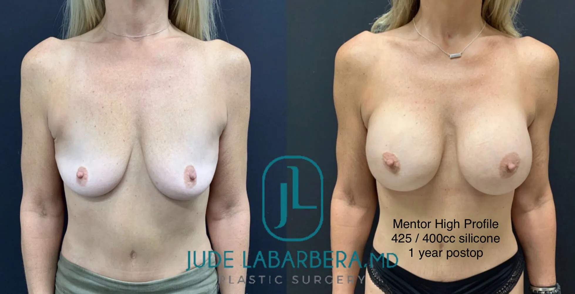 BREAST AUGMENTATION Before & After Case Number 00059