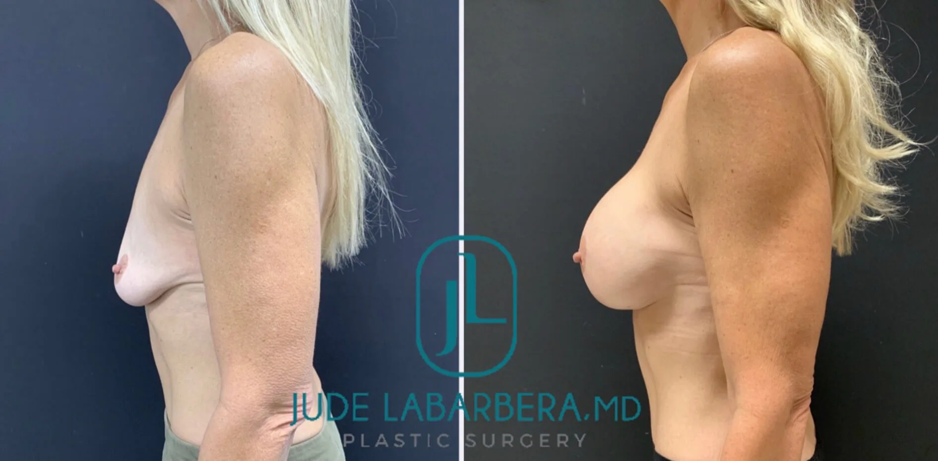 BREAST AUGMENTATION Before & After Case Number 00059