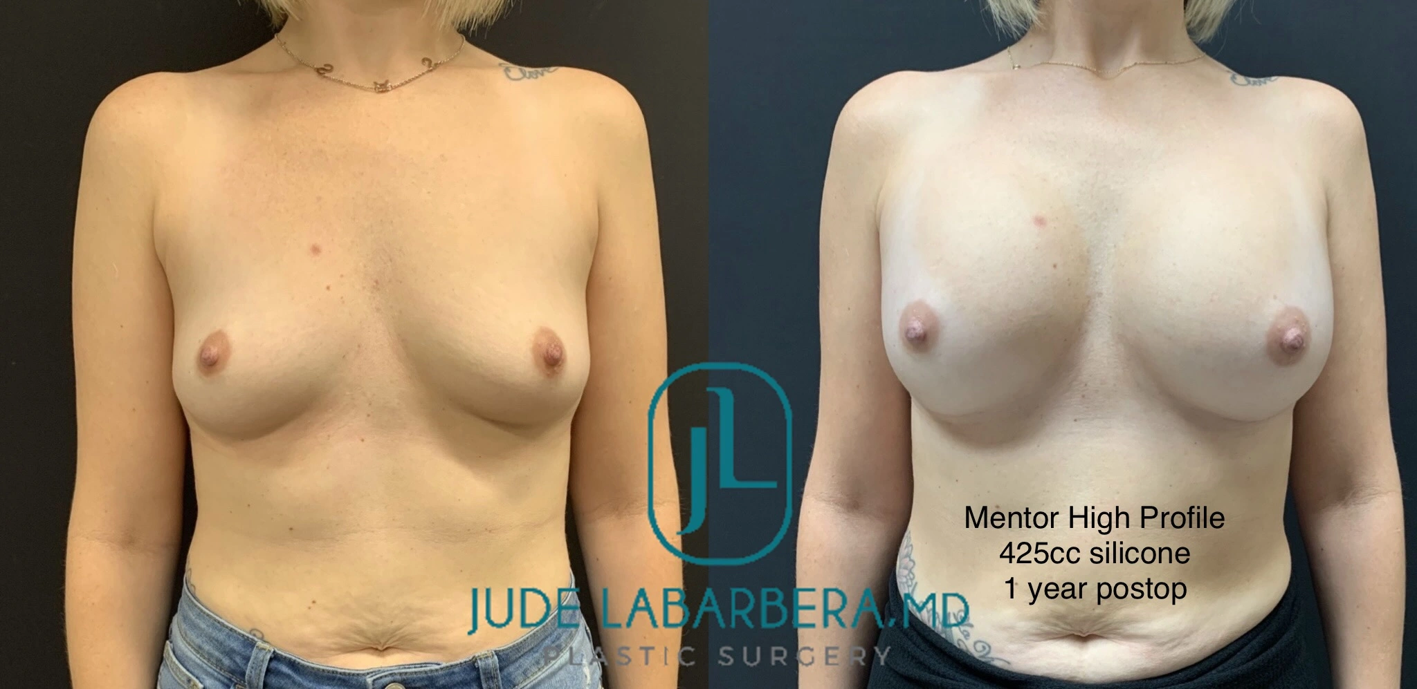 BREAST AUGMENTATION Before & After Case Number 00060