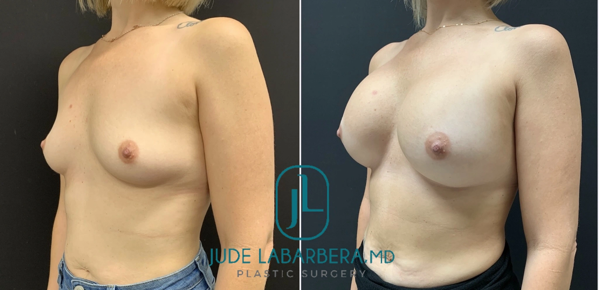 BREAST AUGMENTATION Before & After Case Number 00060