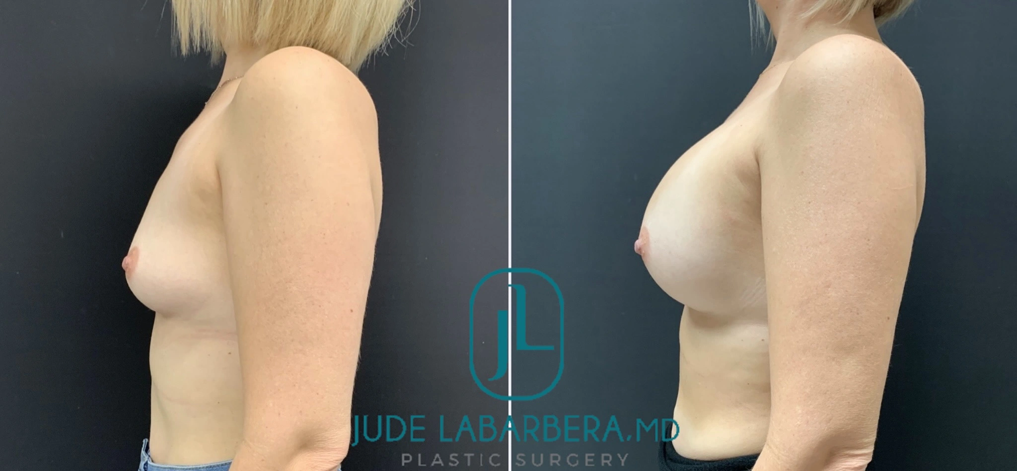 BREAST AUGMENTATION Before & After Case Number 00060