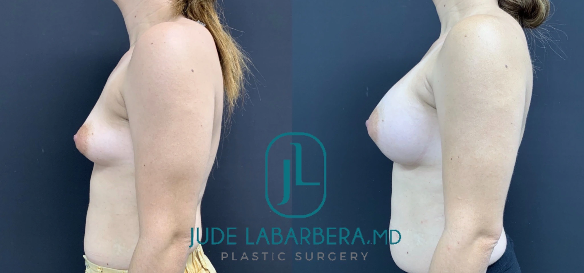 BREAST AUGMENTATION Before & After Case Number 00063