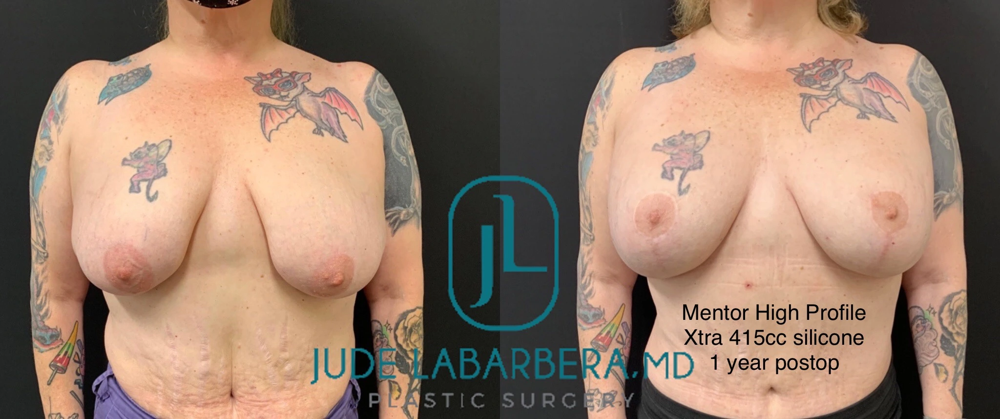 BREAST AUGMENTATION WITH LIFT Before & After Case Number 0003