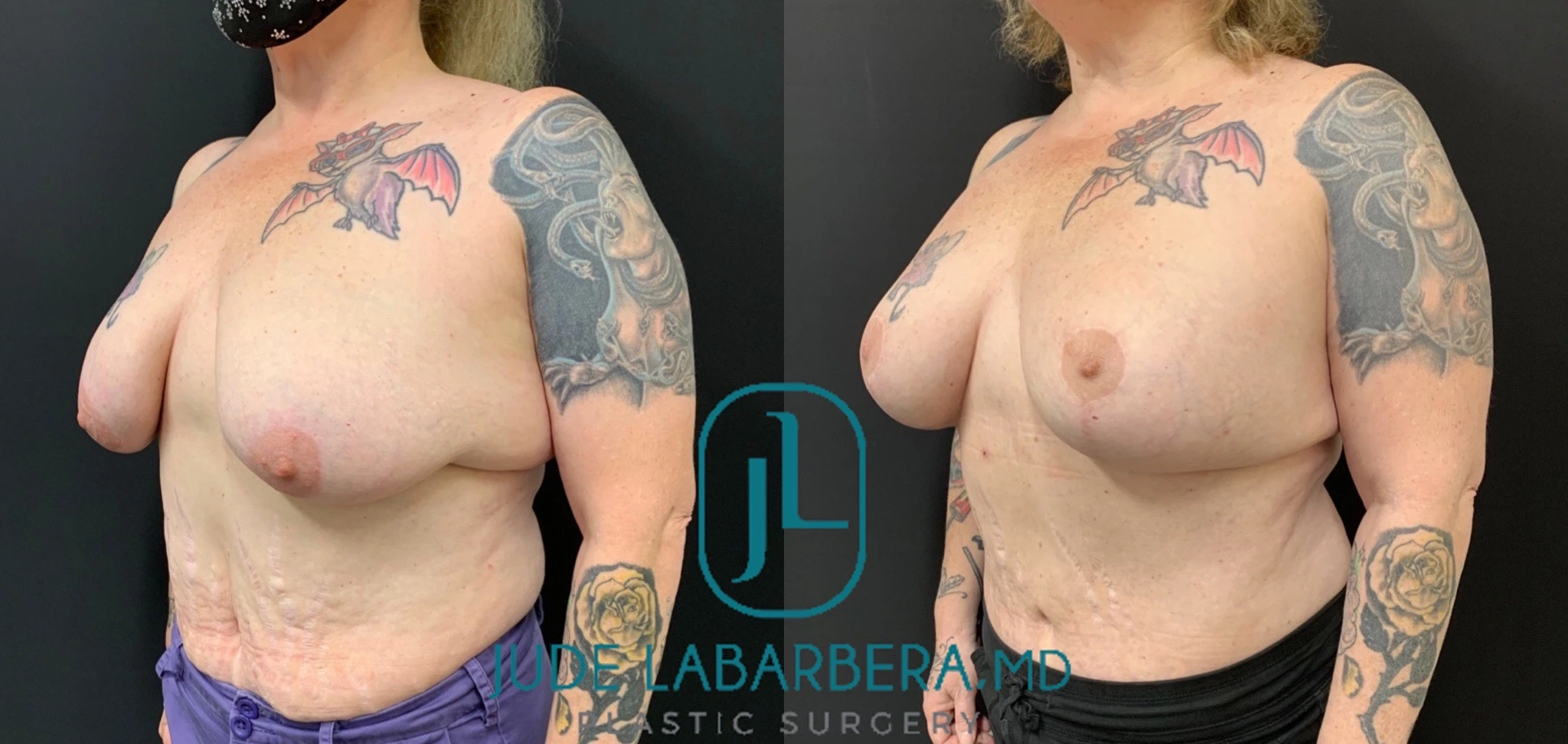 BREAST AUGMENTATION WITH LIFT Before & After Case Number 0003